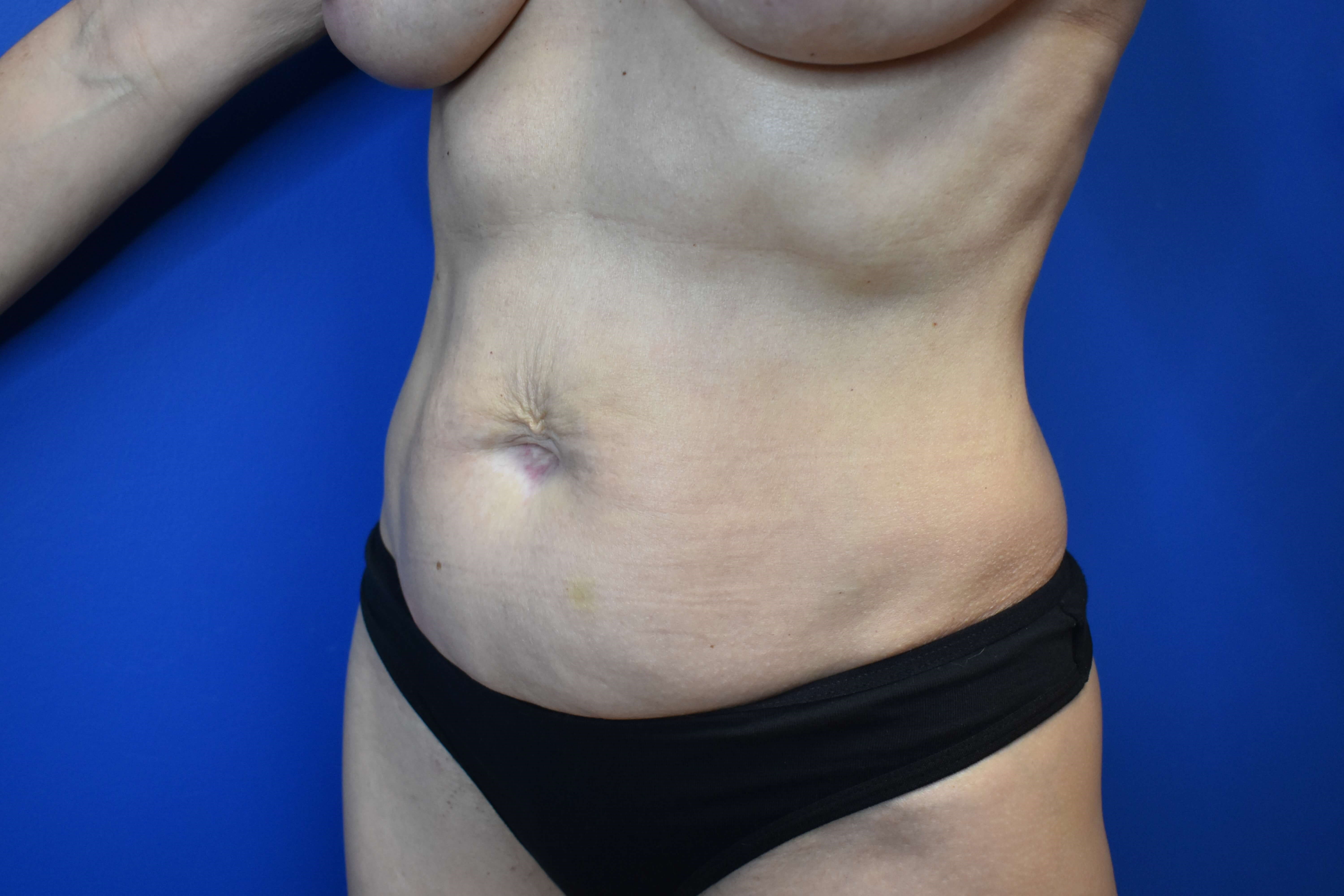 Abdominoplasty Before