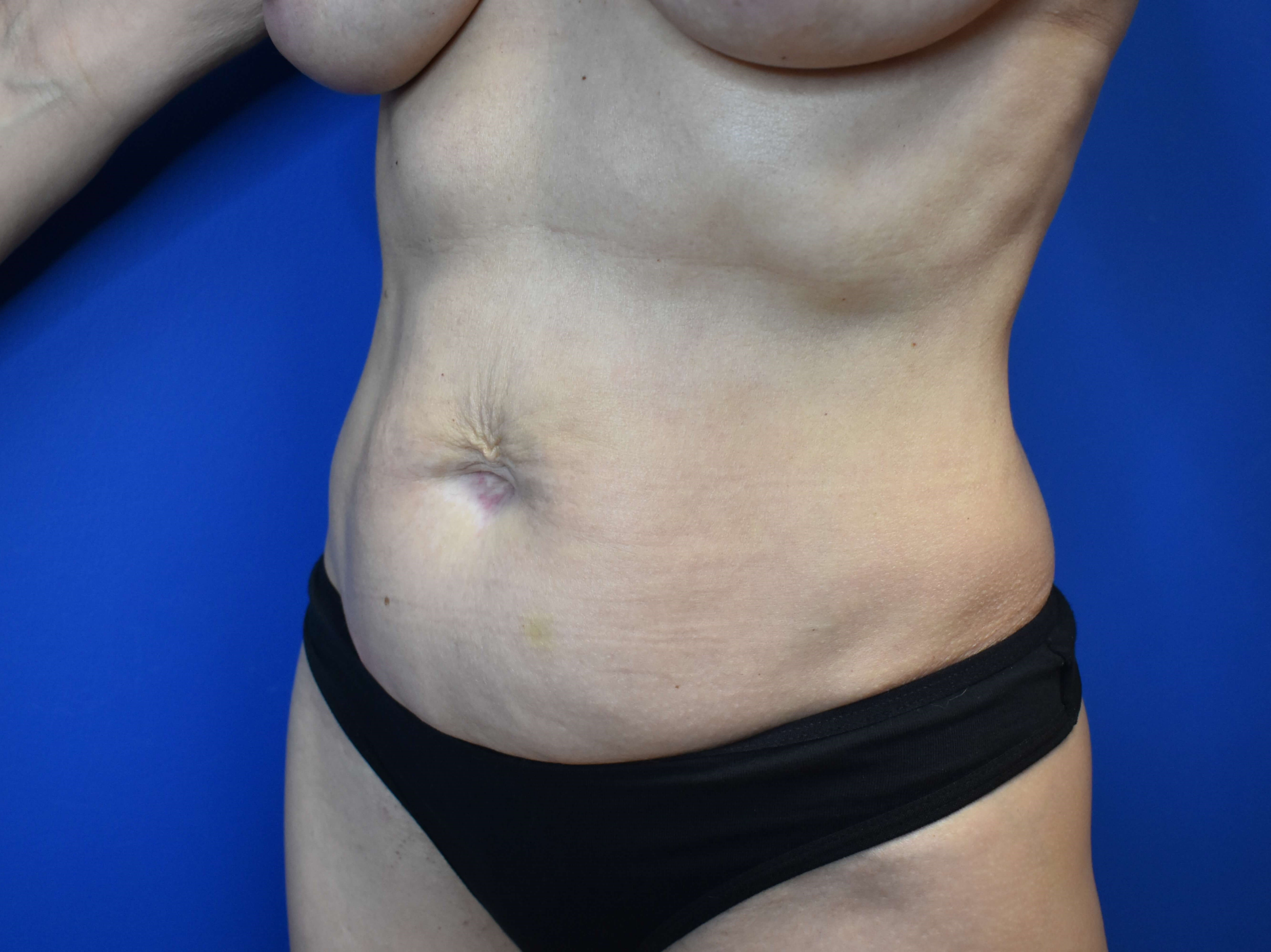 Abdominoplasty Before