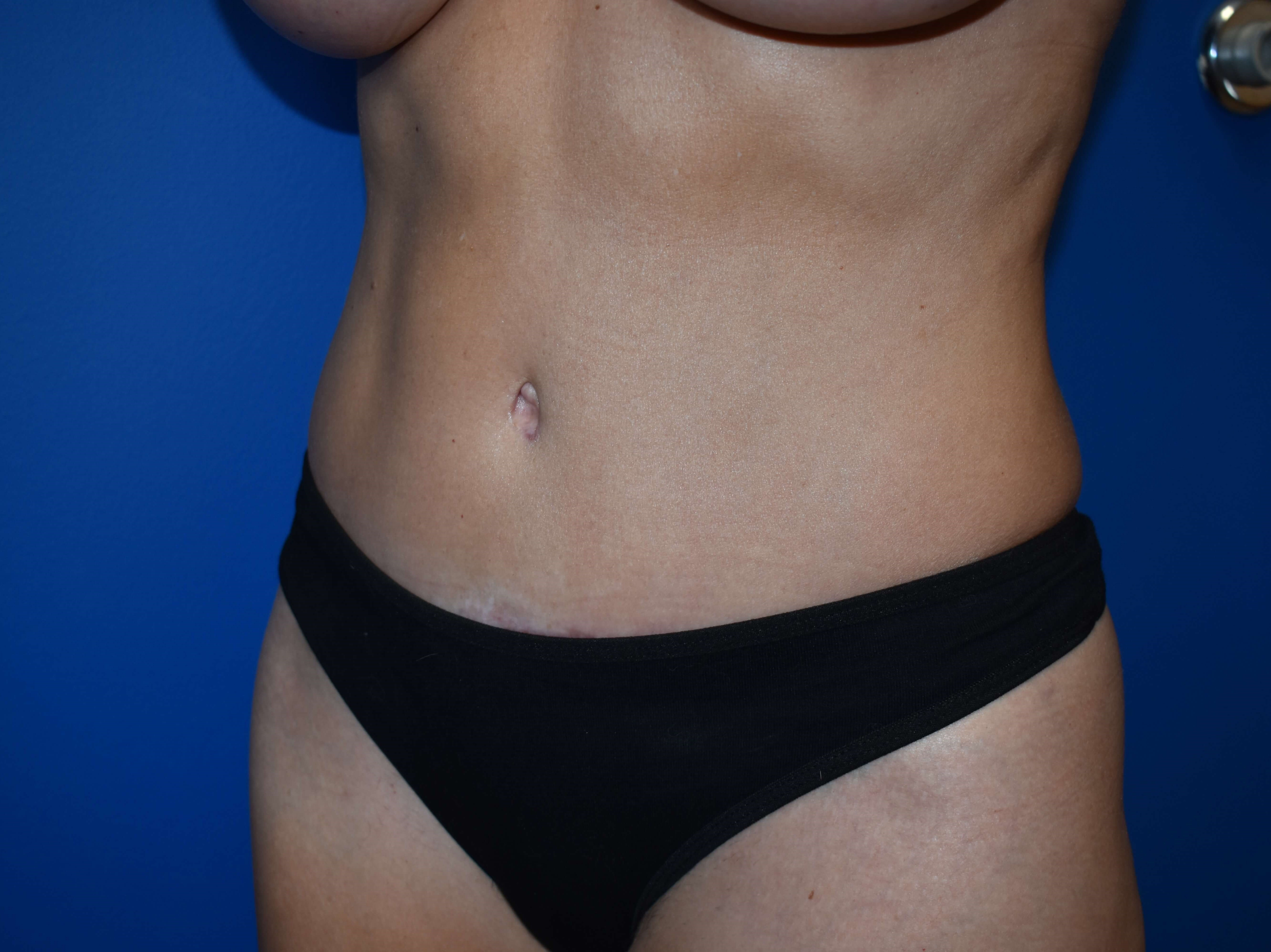 Abdominoplasty After