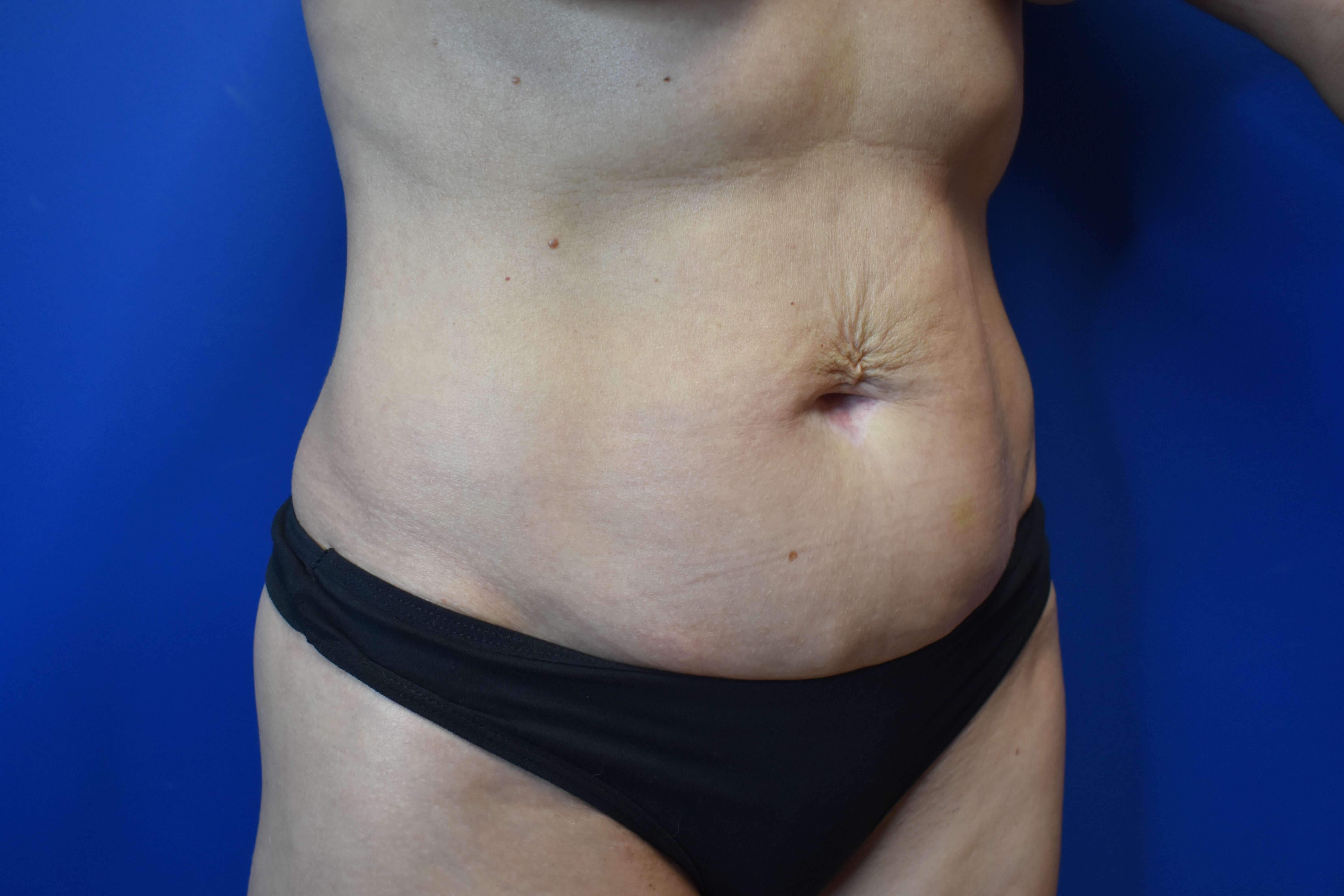 Abdominoplasty Before