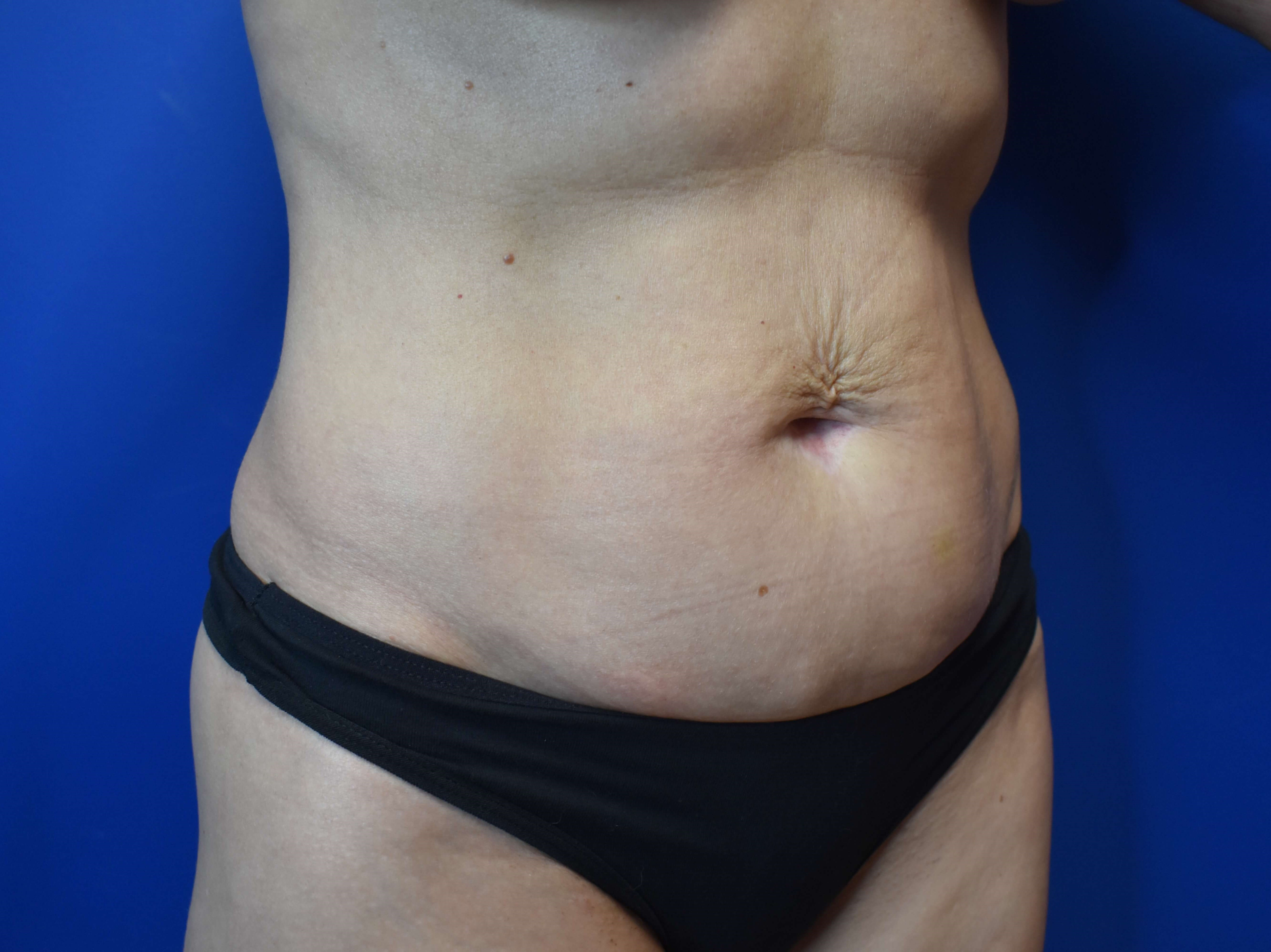 Abdominoplasty Before