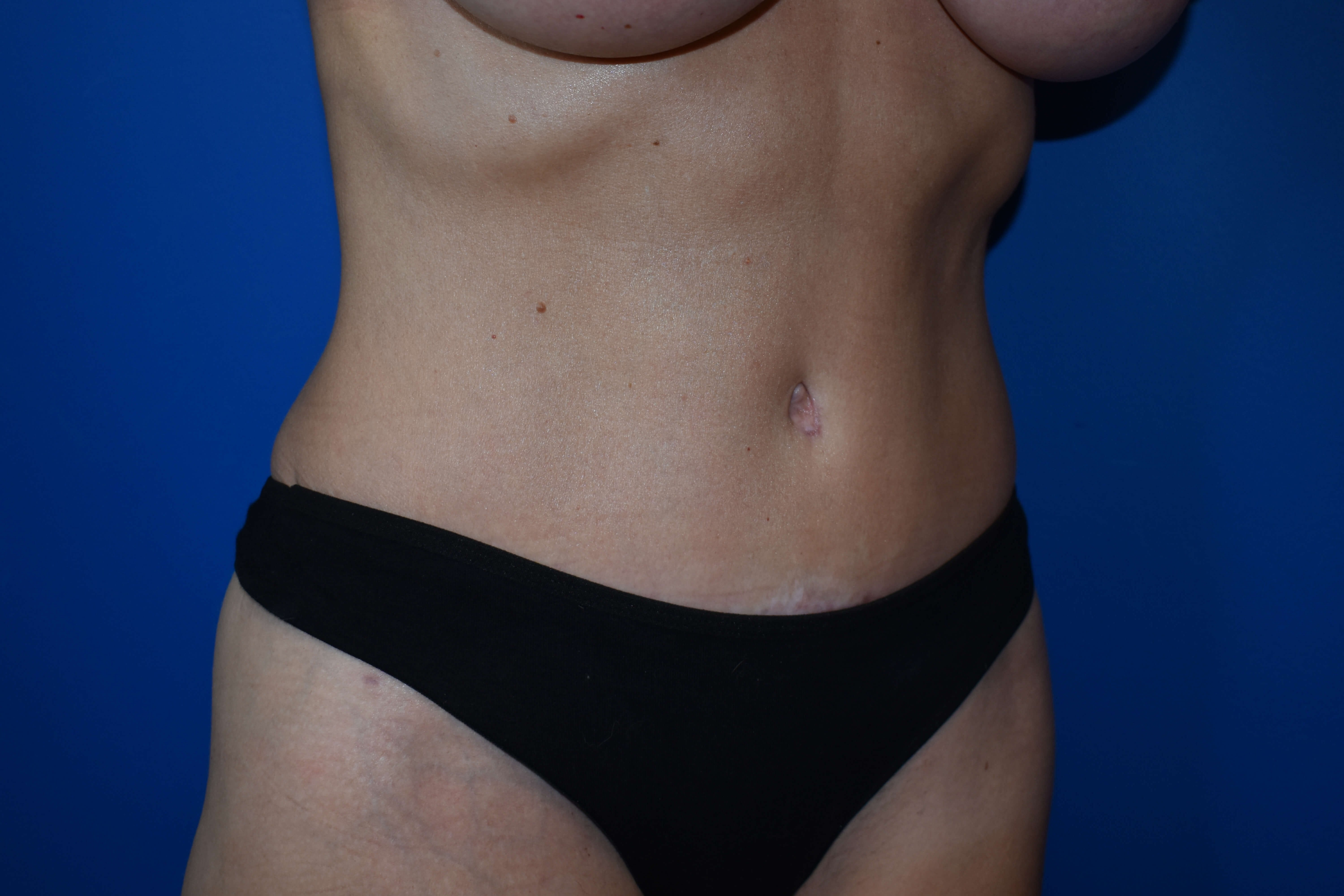 Abdominoplasty After