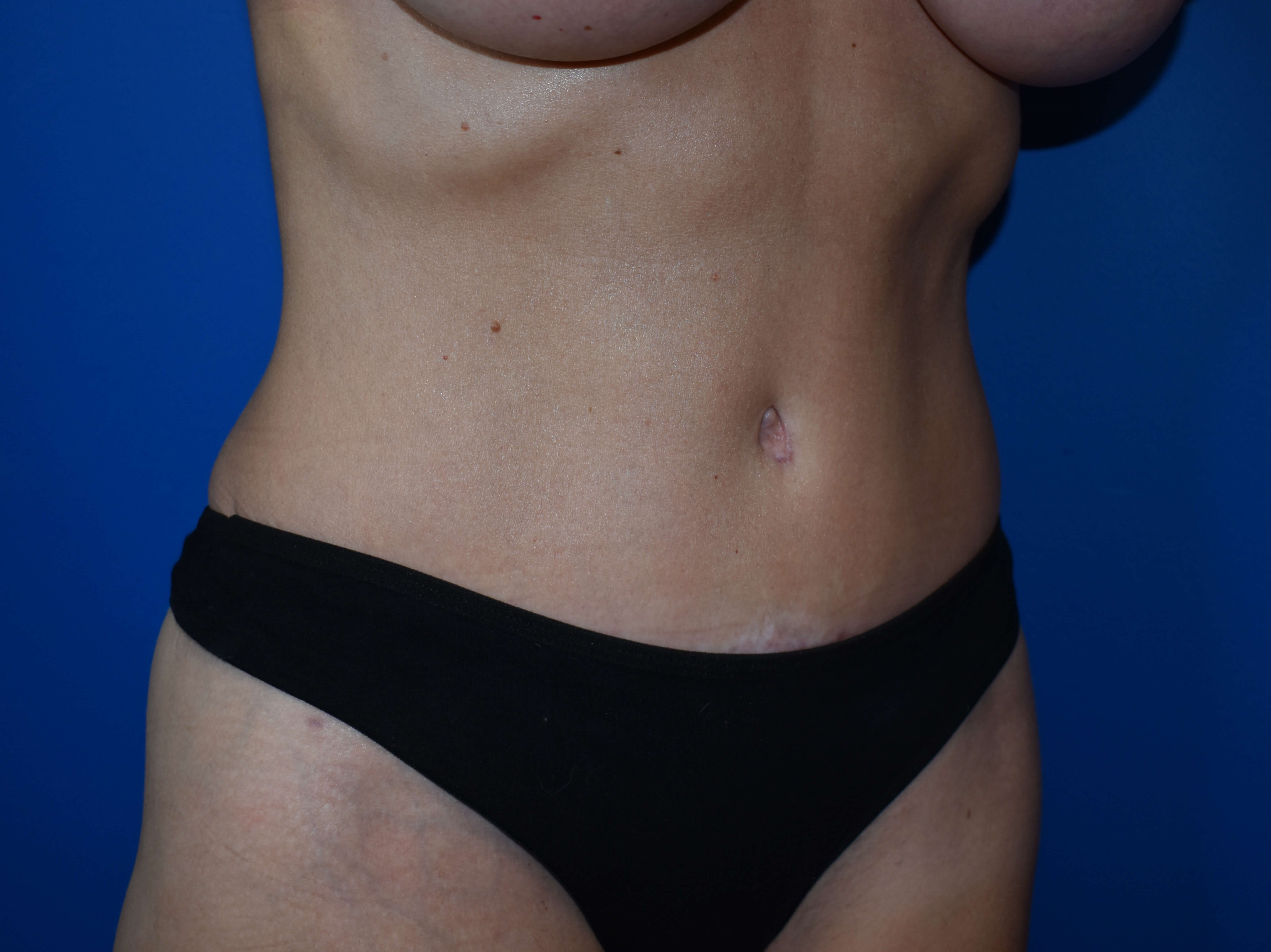 Abdominoplasty After
