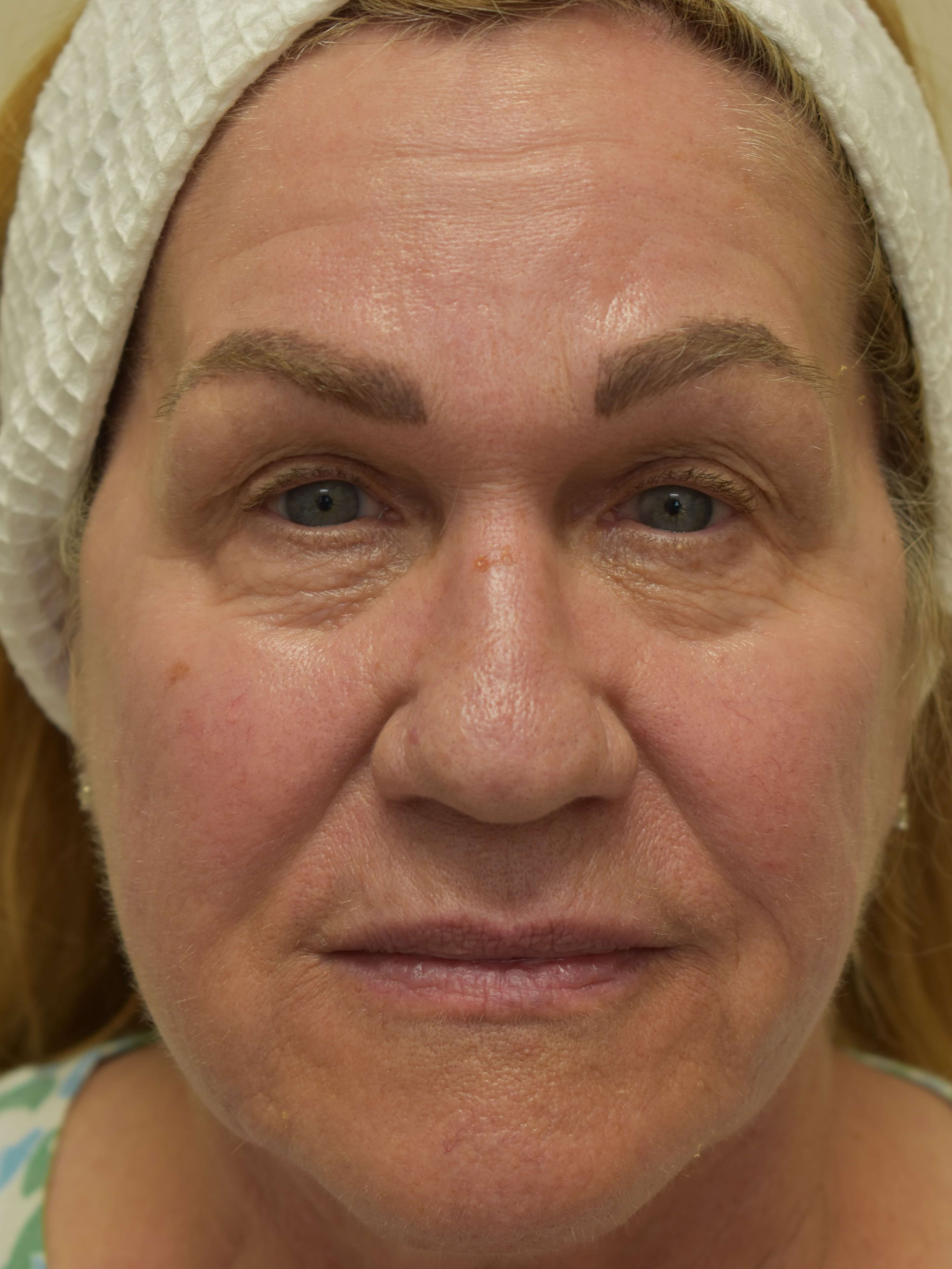 Facial Rejuvenation with Halo Before