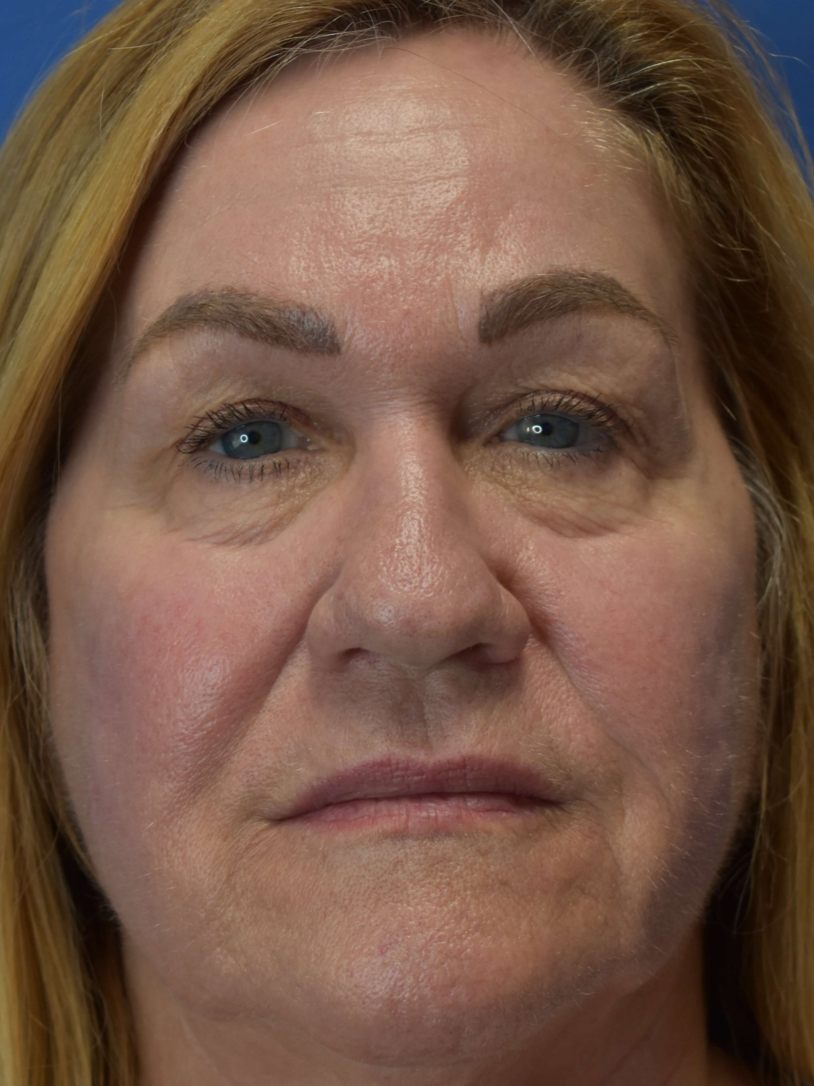 Facial Rejuvenation with Halo After