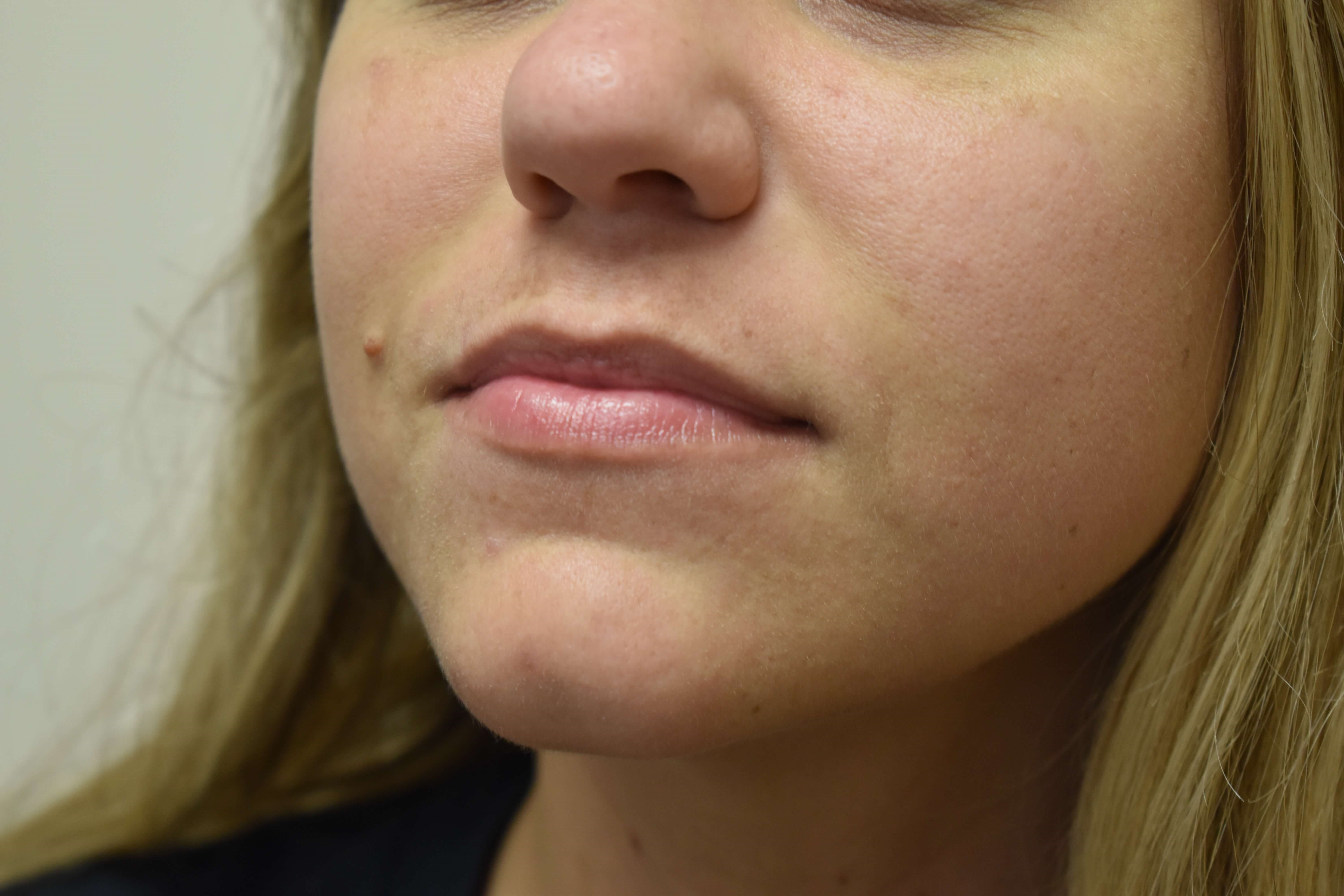 Smile Line Correction Before