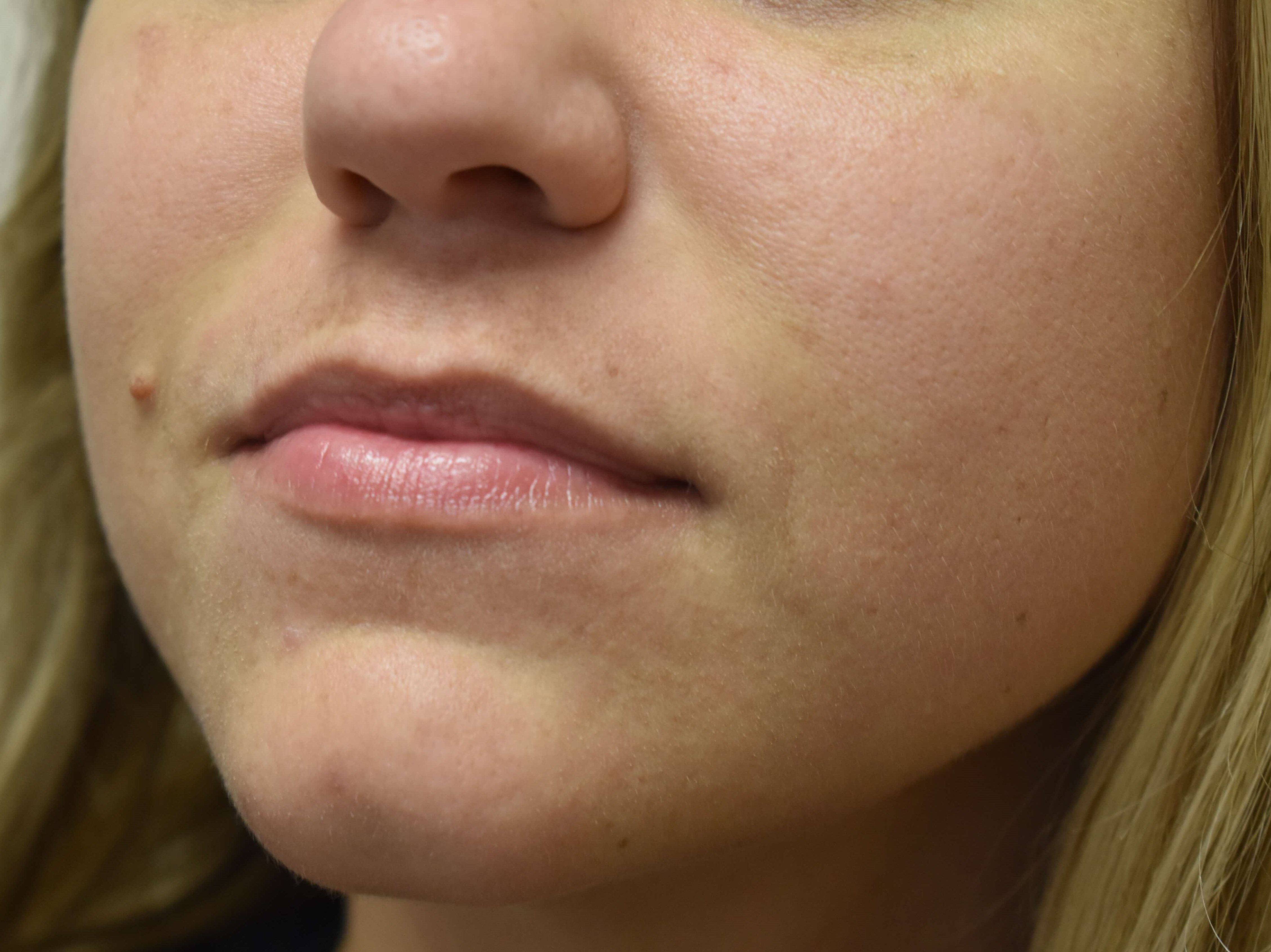 Smile Line Correction Before