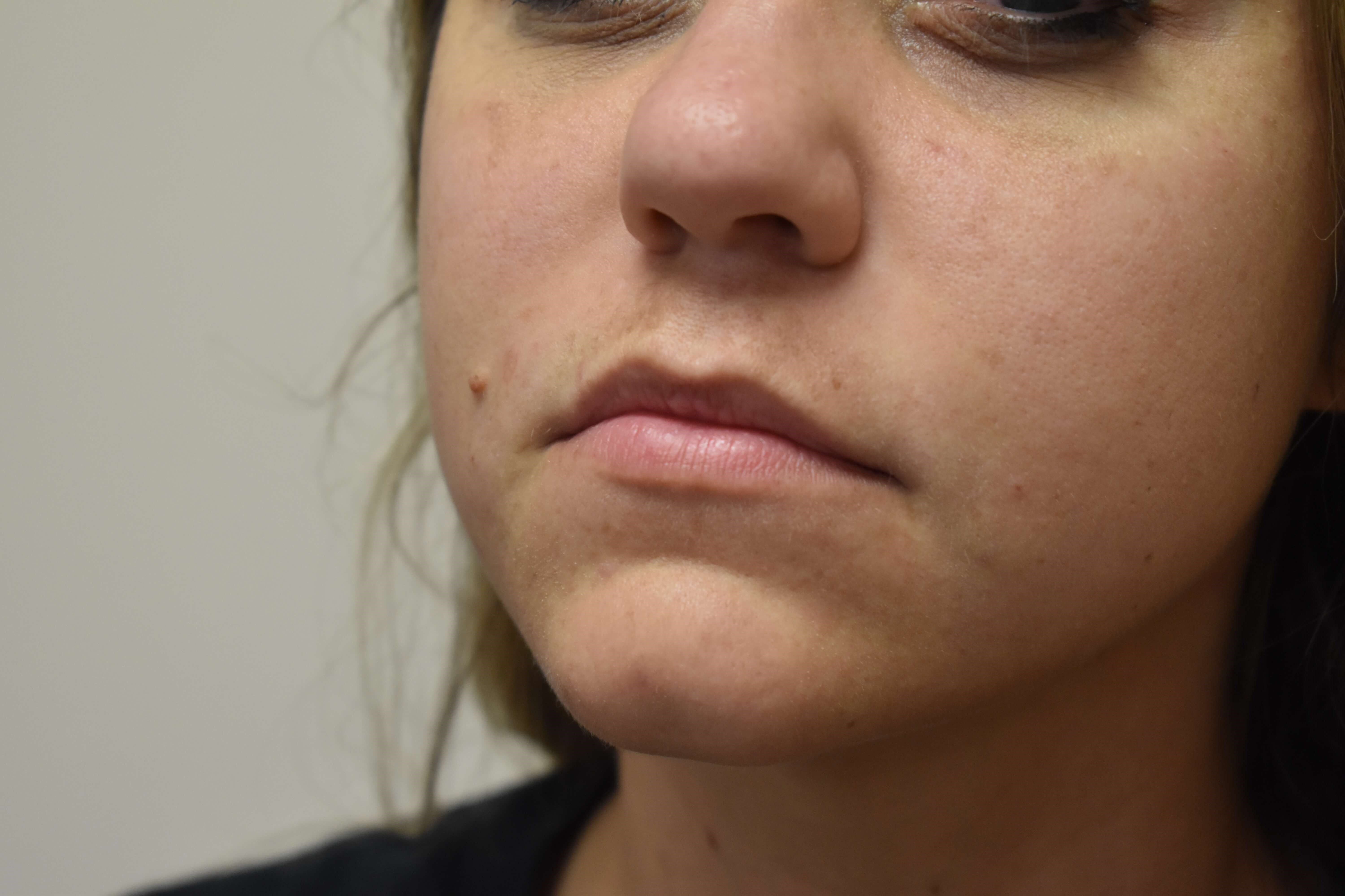 Smile Line Correction After