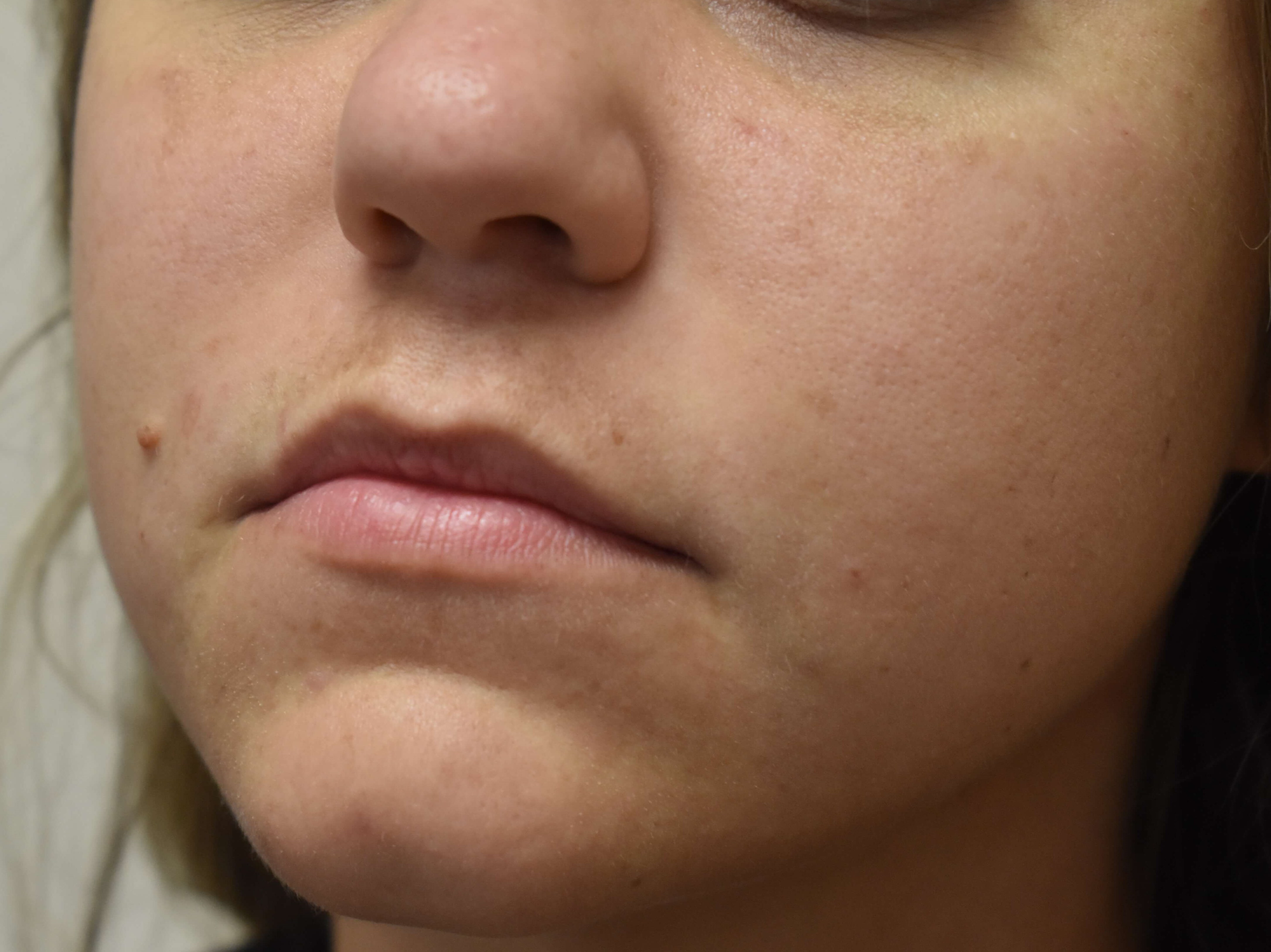 Smile Line Correction After