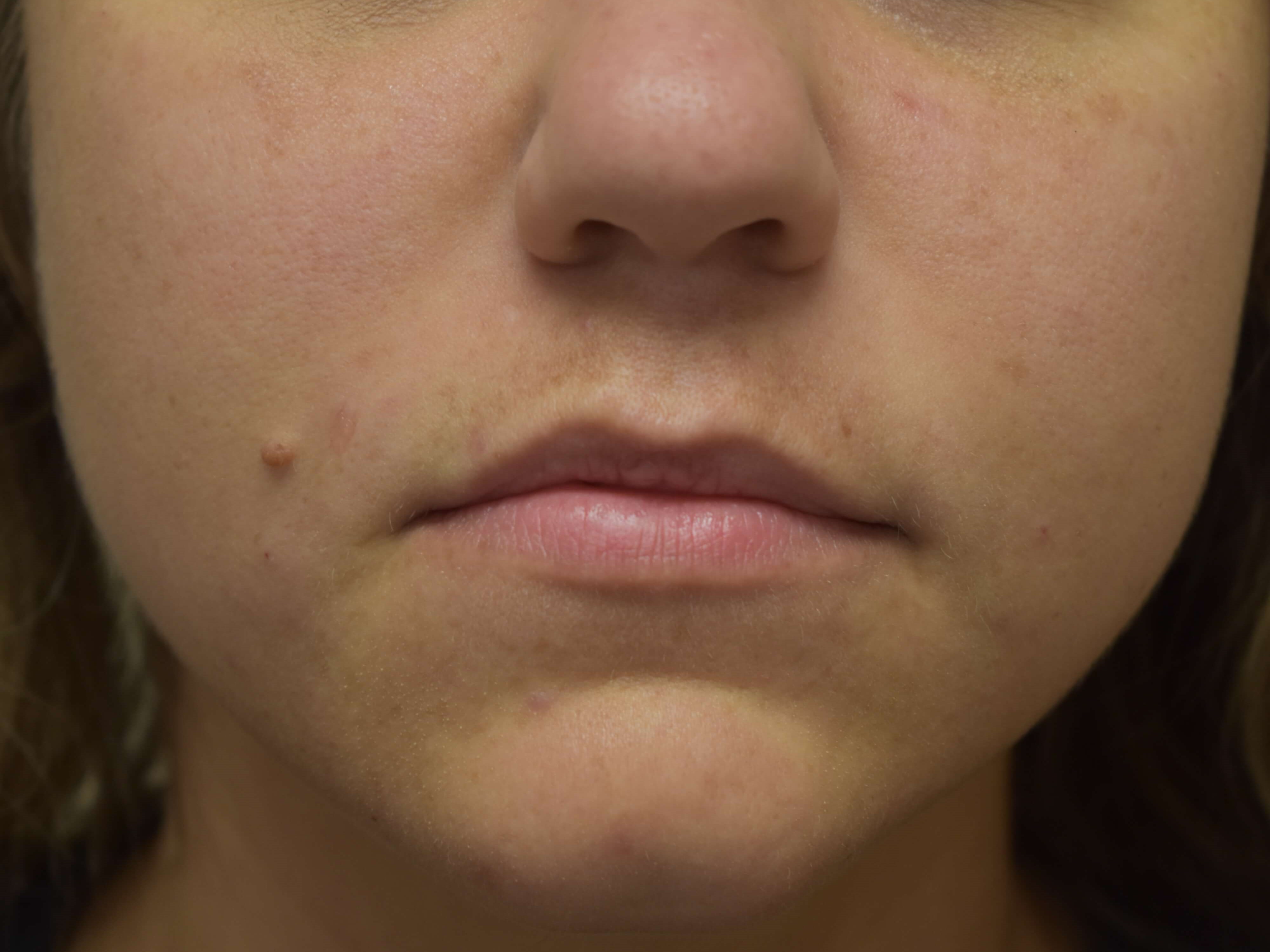 Smile Line Correction After