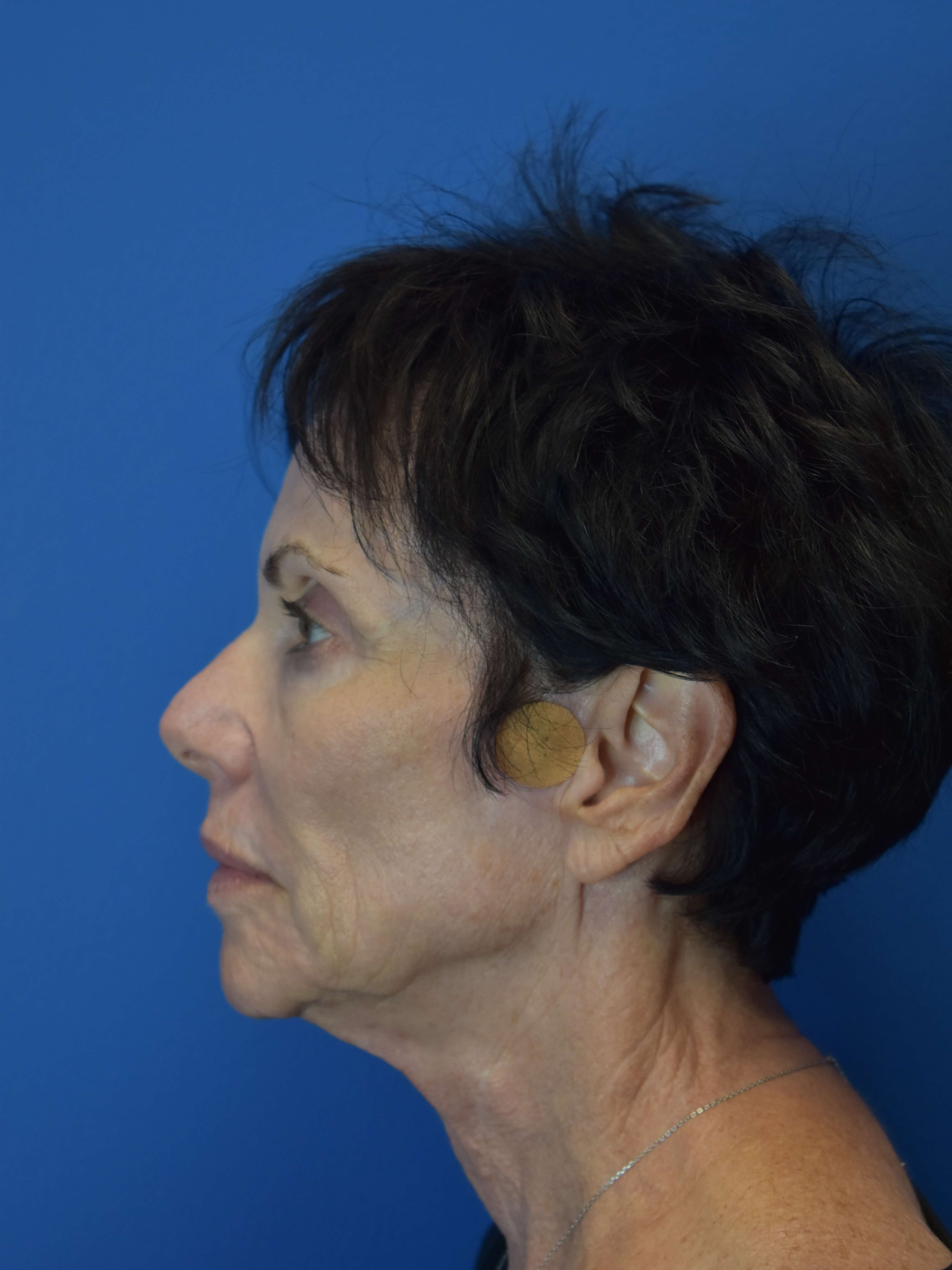 Sofwave - Face and Neck Before
