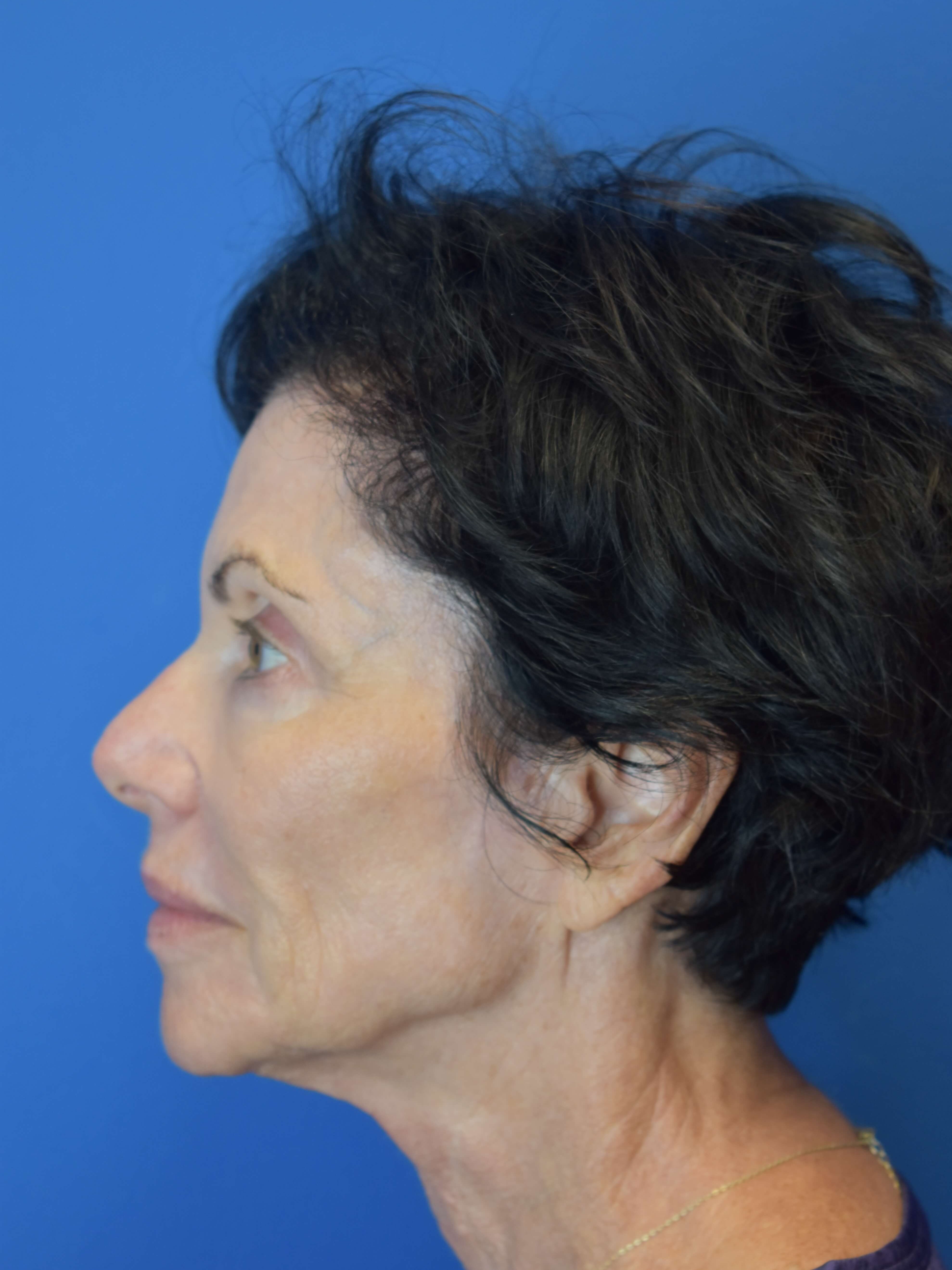 Sofwave - Face and Neck After