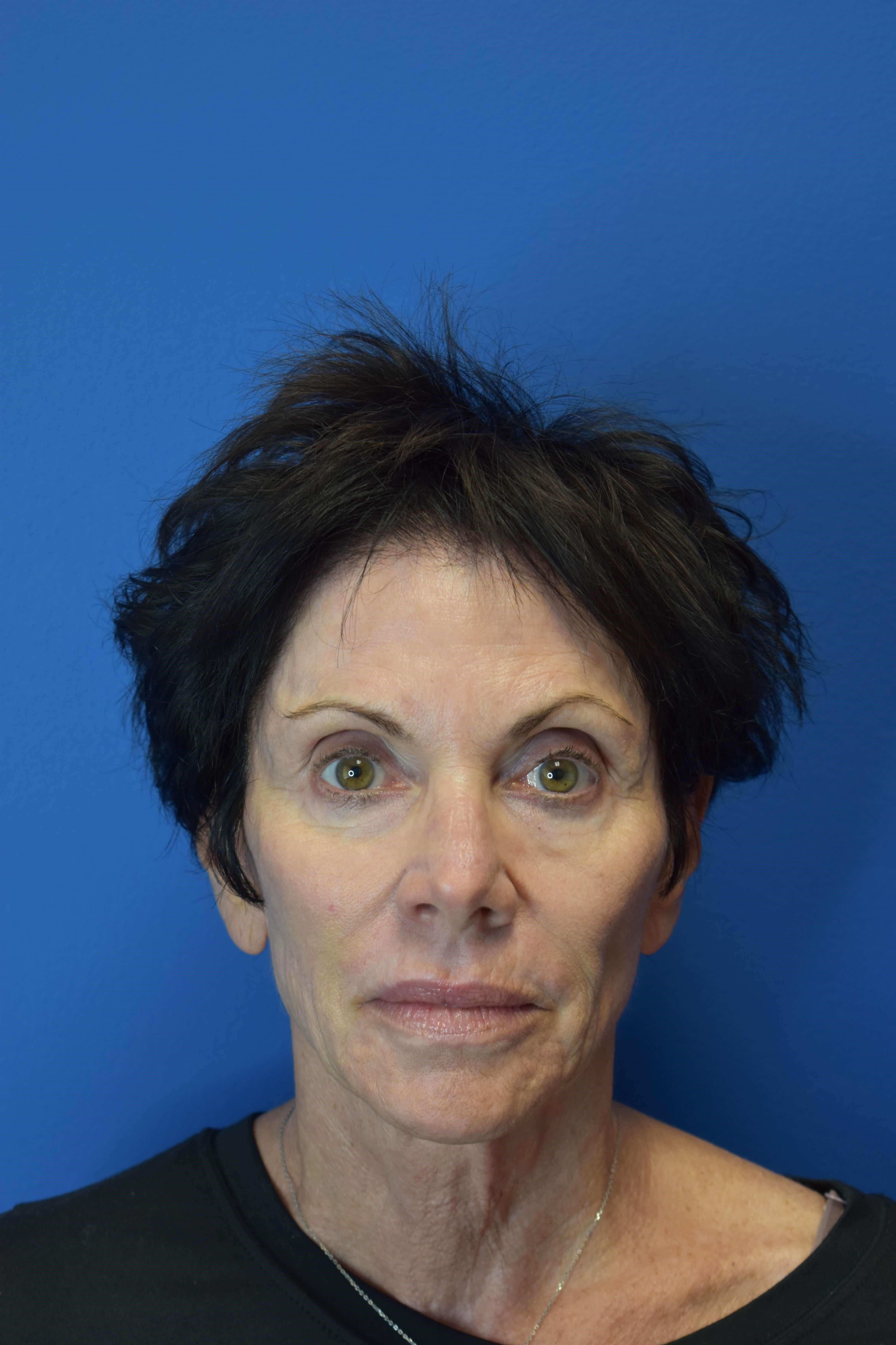 Sofwave- Face and Neck Before
