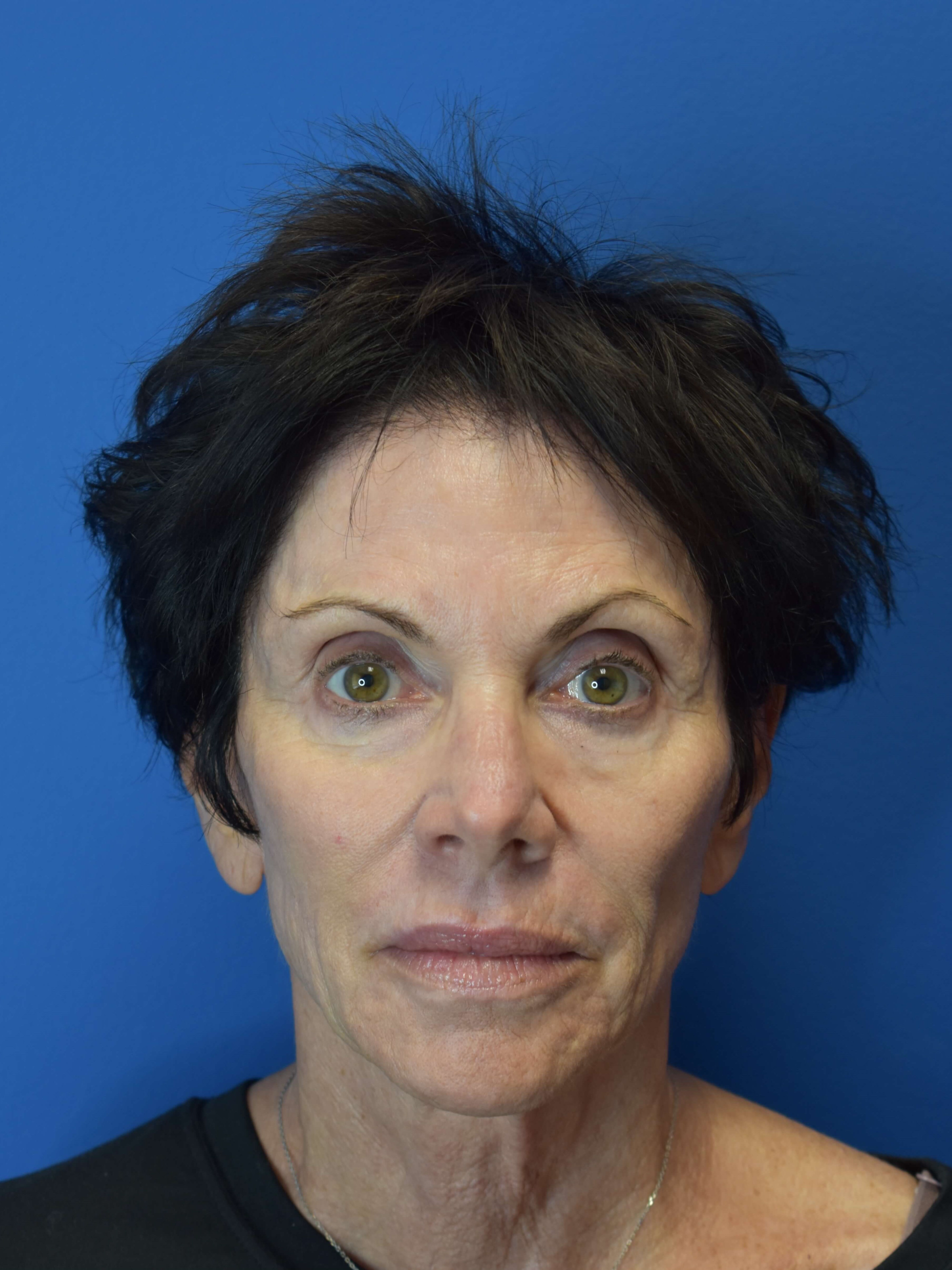 Sofwave- Face and Neck Before