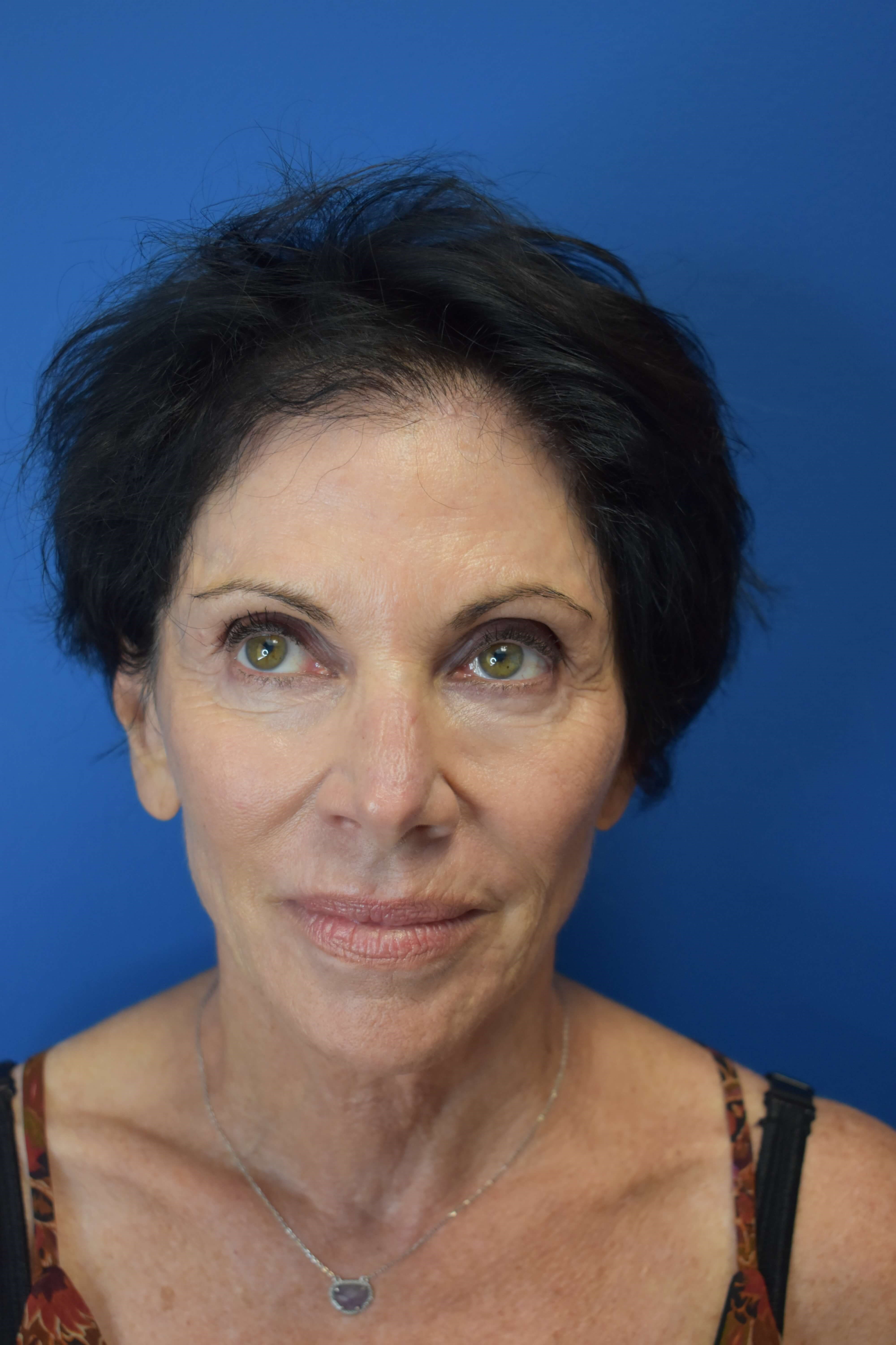 Sofwave- Face and Neck After