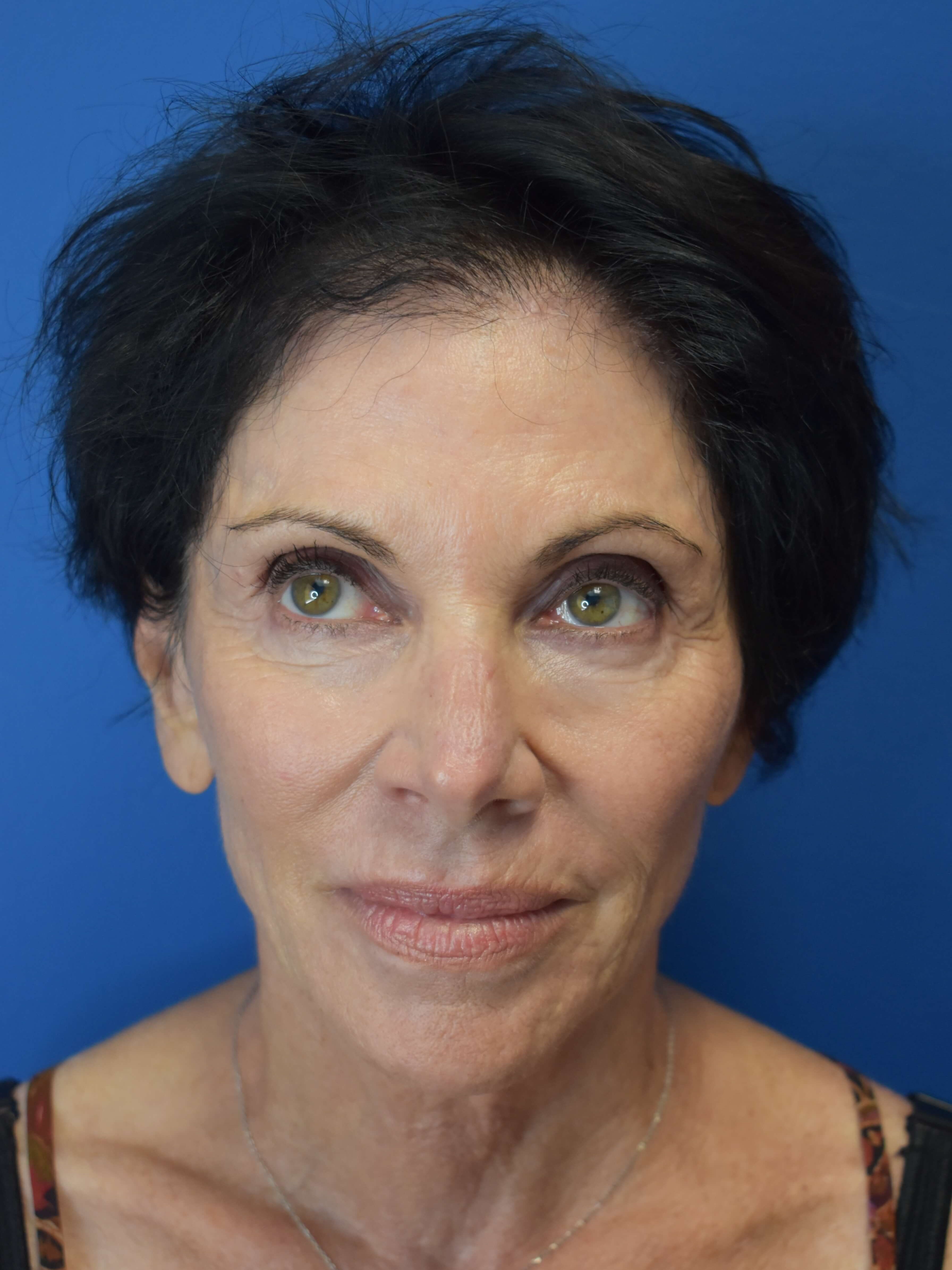 Sofwave- Face and Neck After