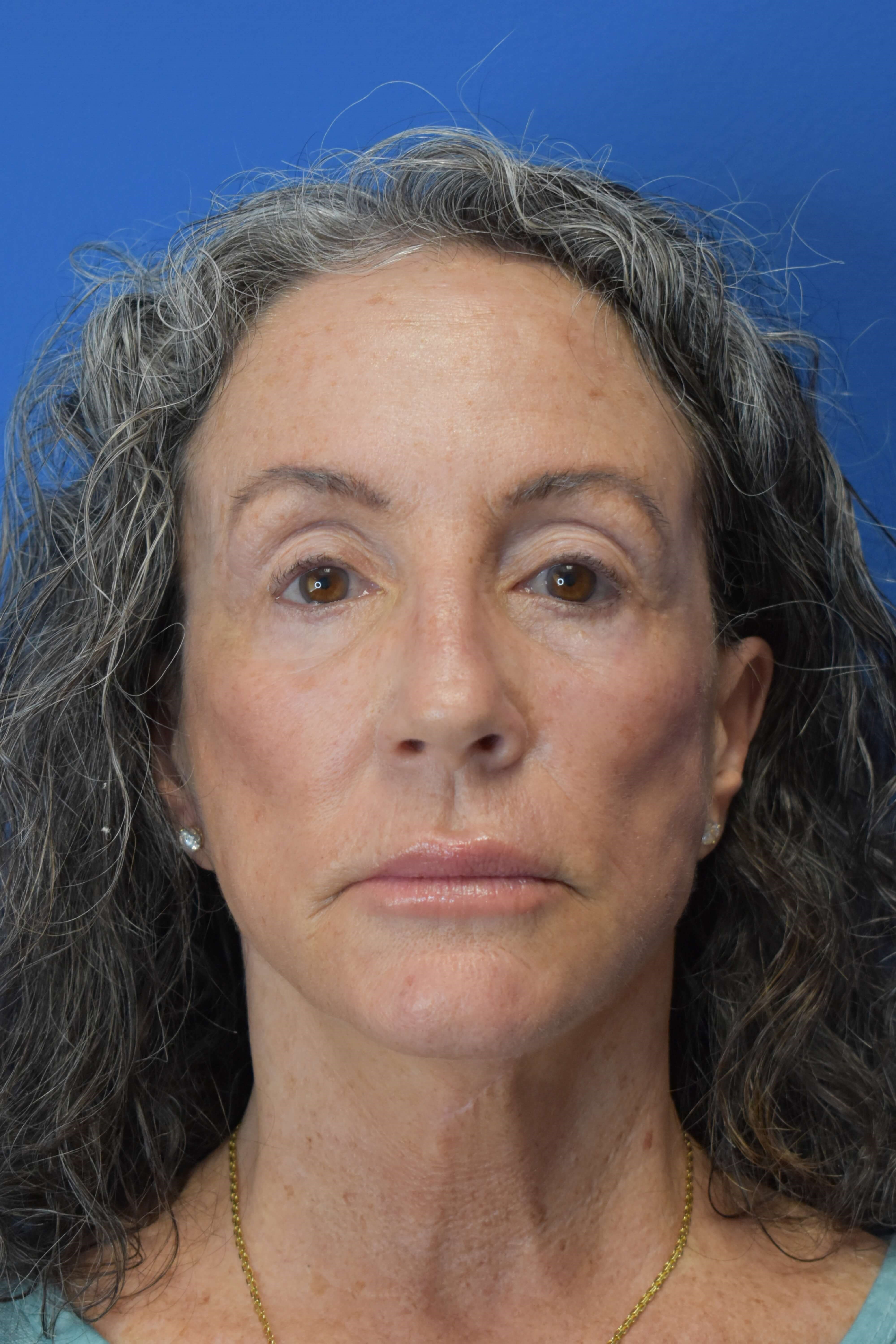 Sciton erbium TRL laser Before