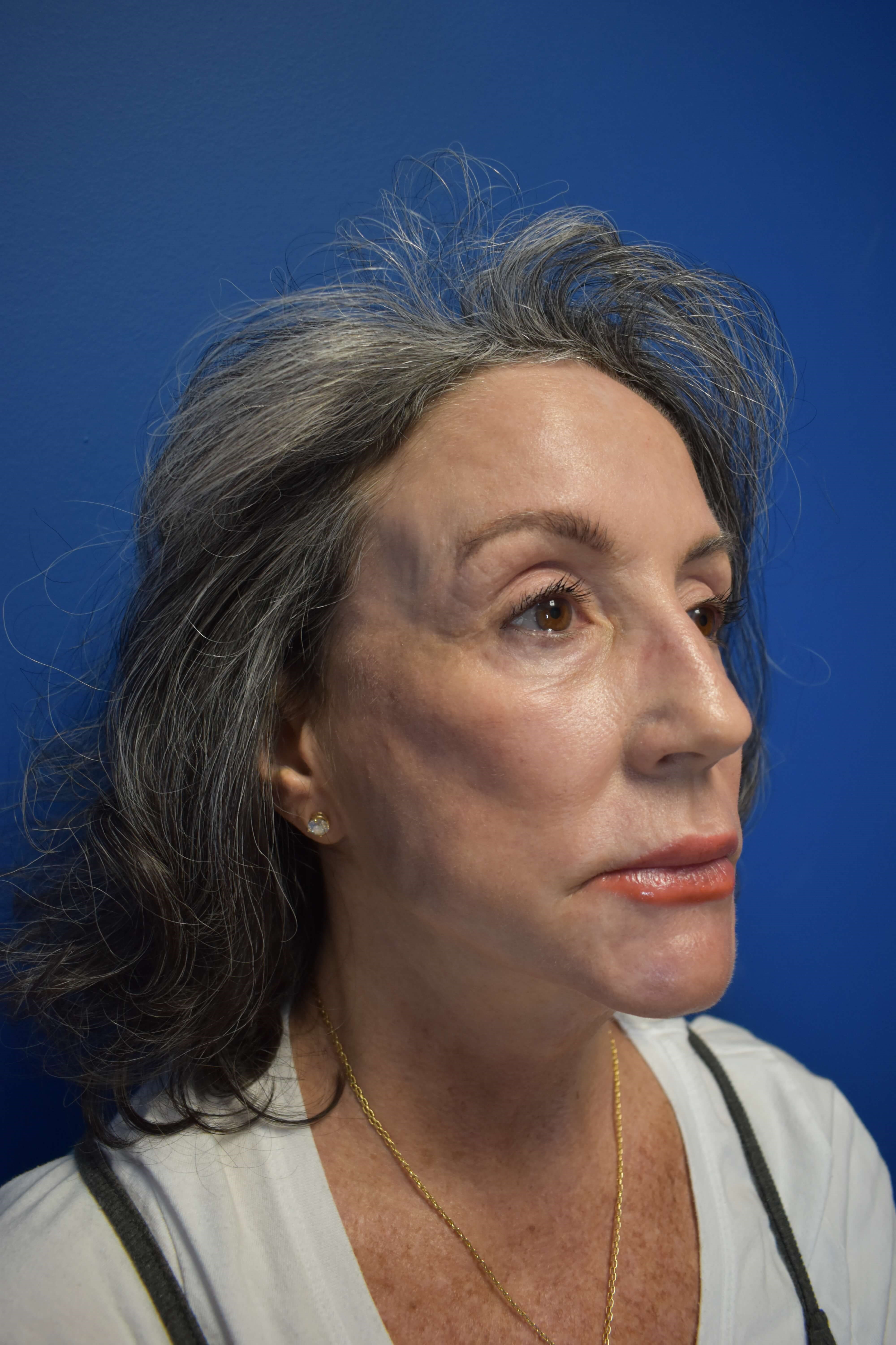 Sciton erbium TRL laser After
