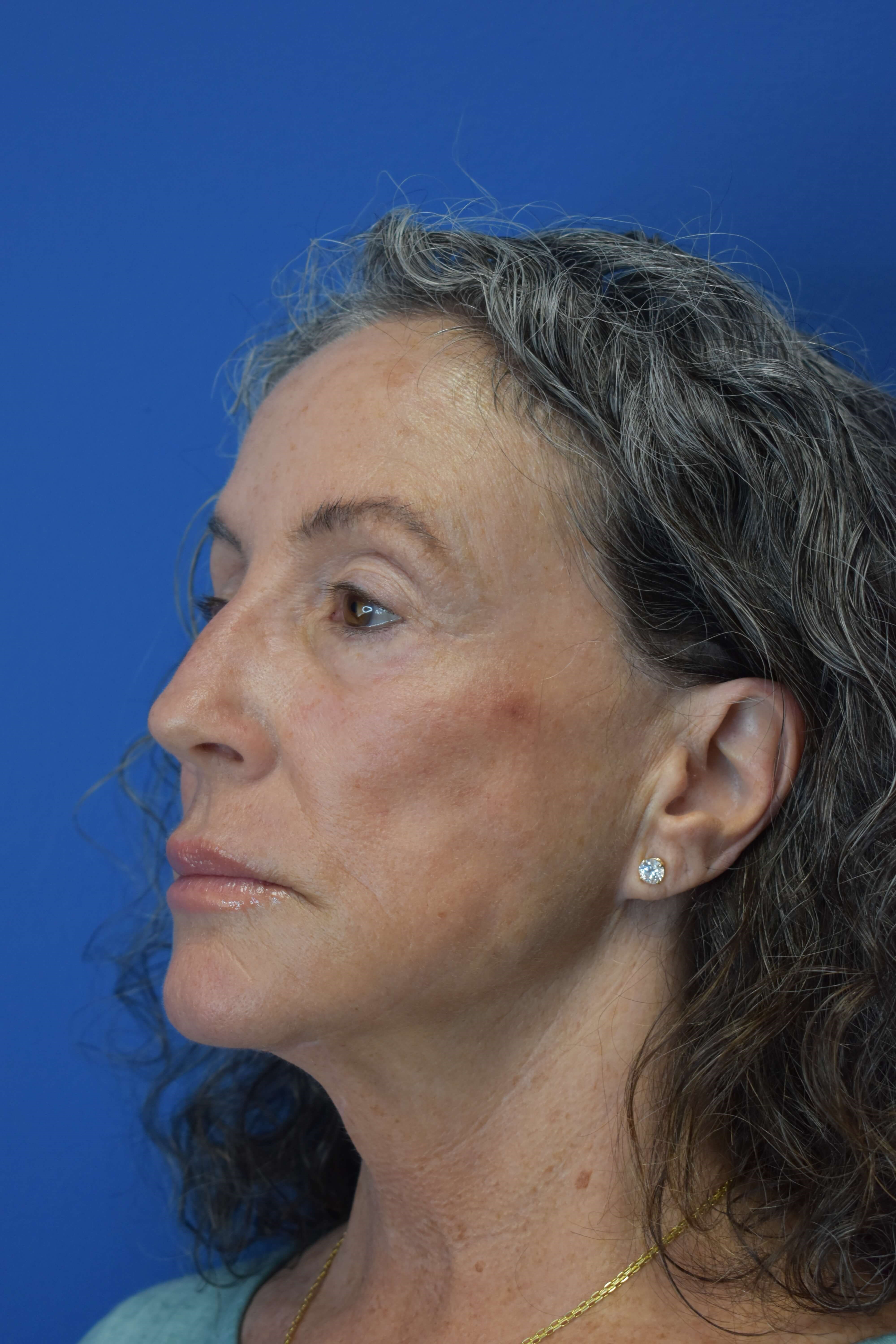 Sciton erbium TRL laser Before