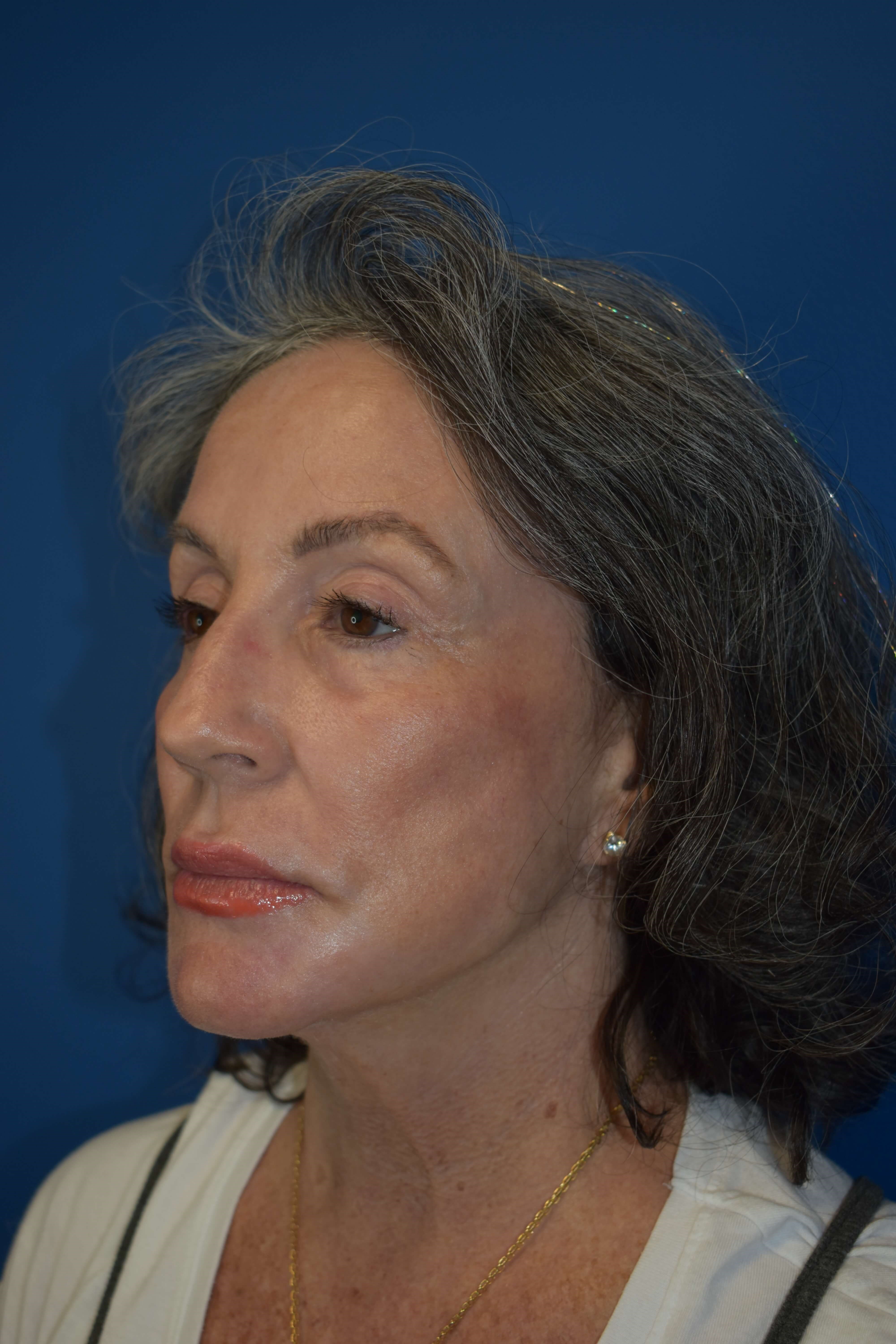 Sciton erbium TRL laser After