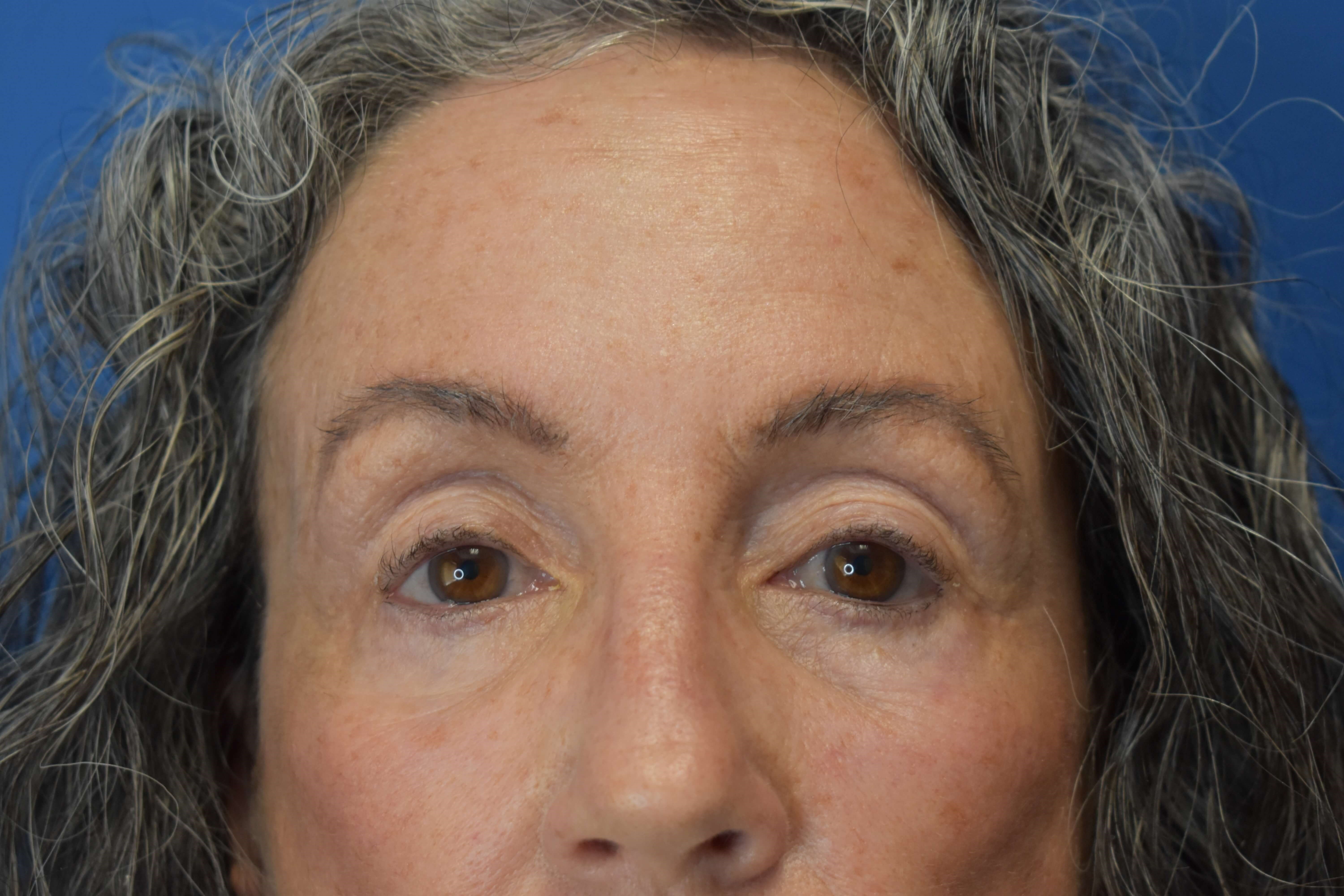Sciton erbium TRL laser Before