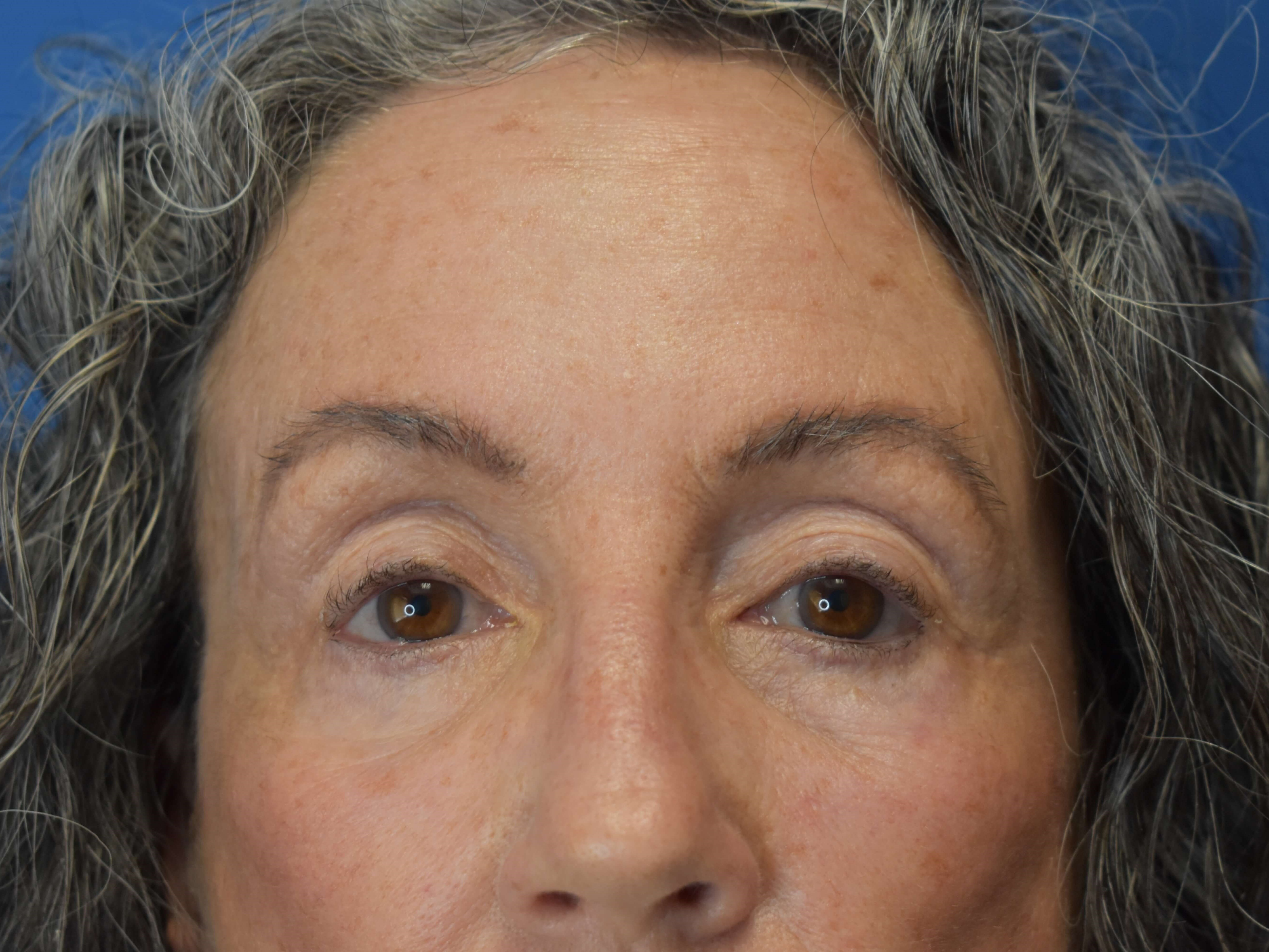 Sciton erbium TRL laser Before