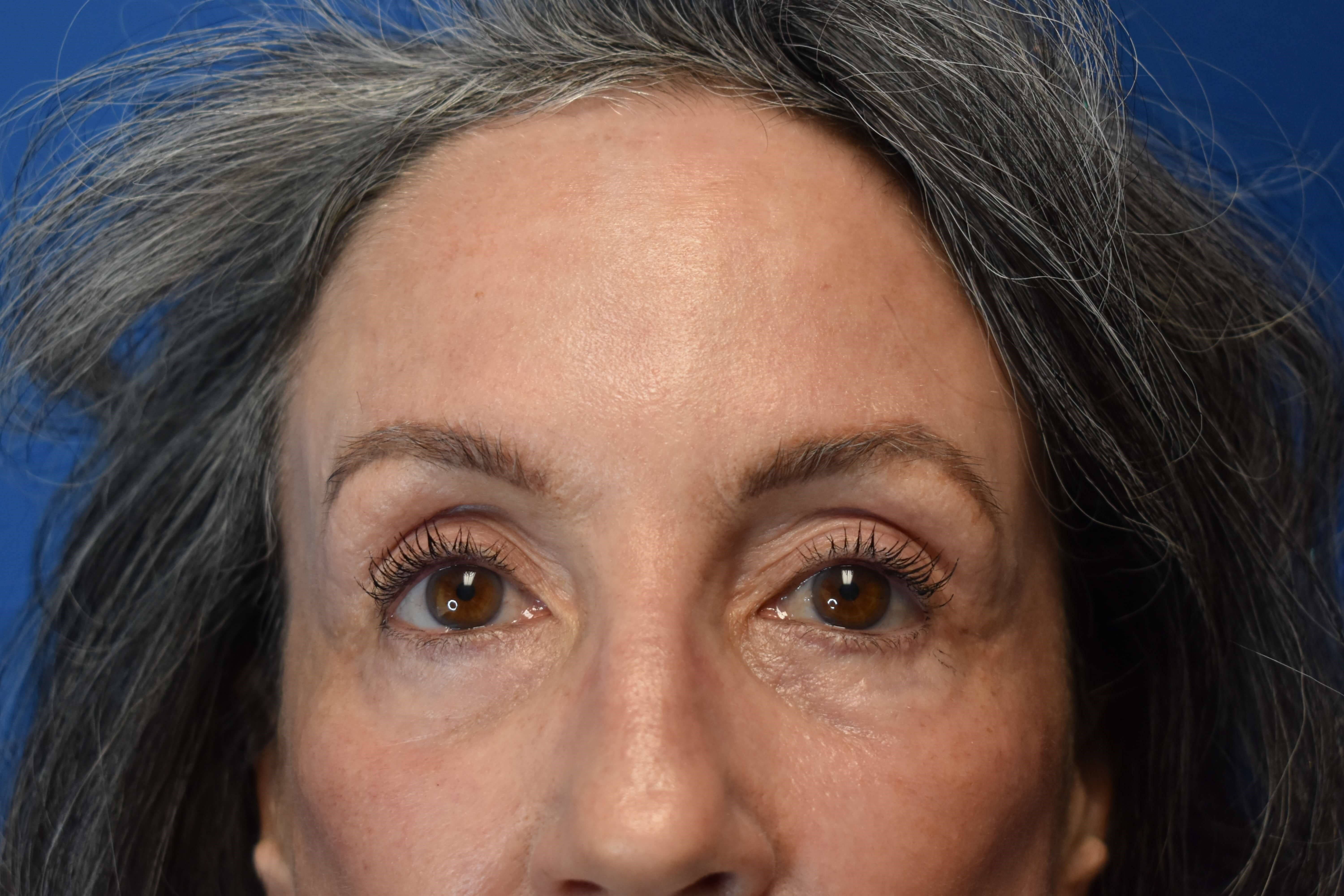 Sciton erbium TRL laser After