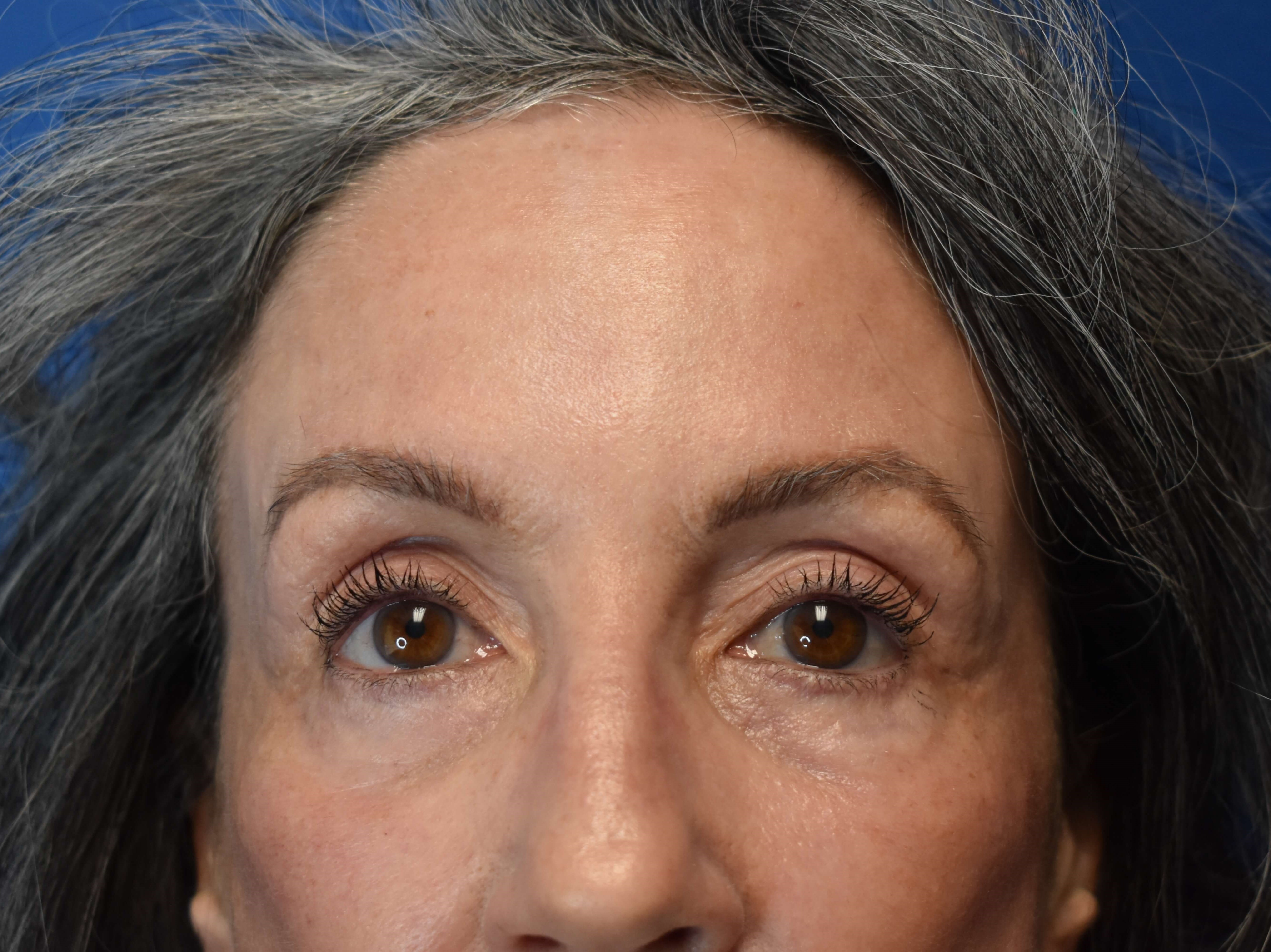 Sciton erbium TRL laser After
