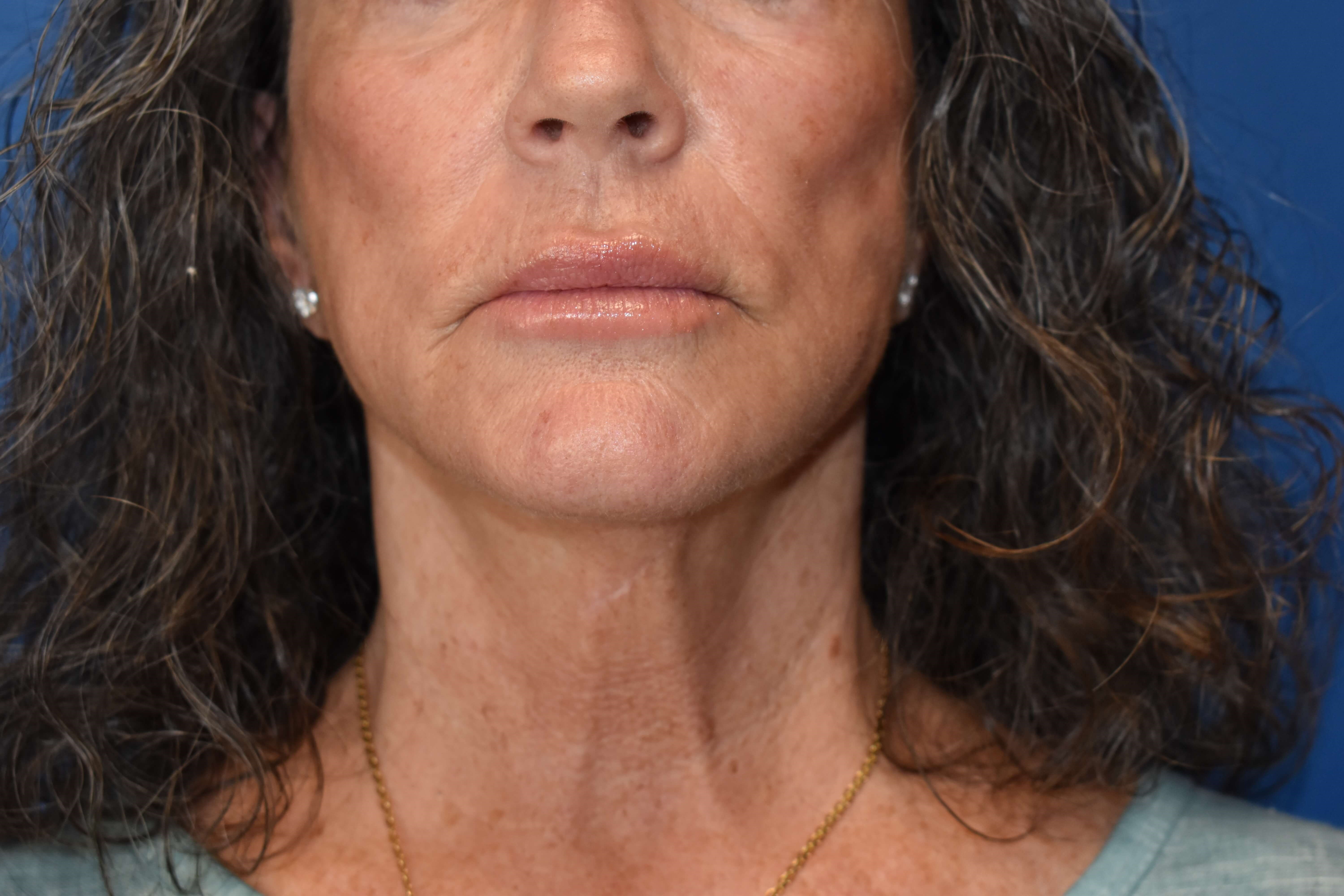 Sciton erbium TRL laser Before