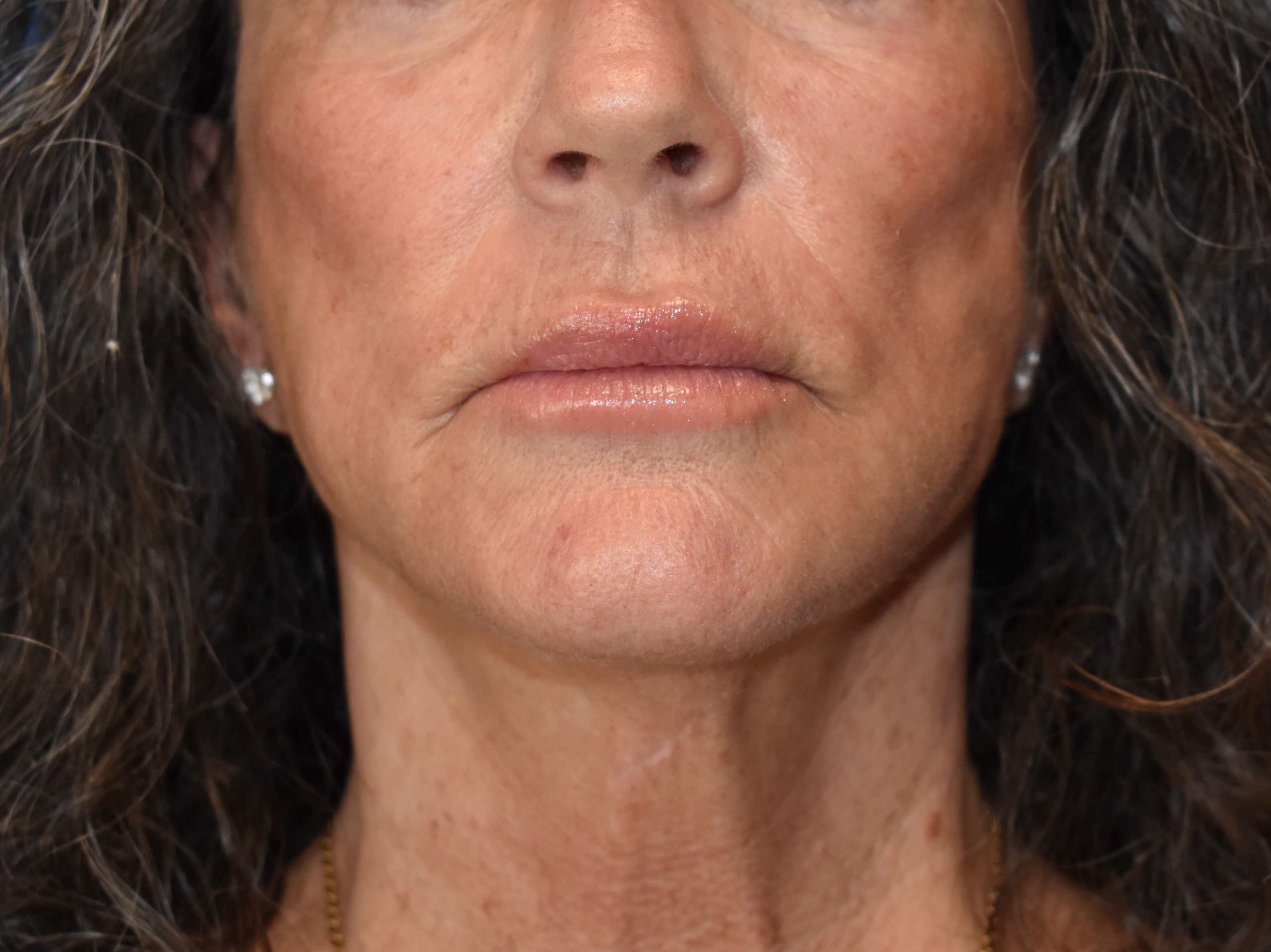 Sciton erbium TRL laser Before