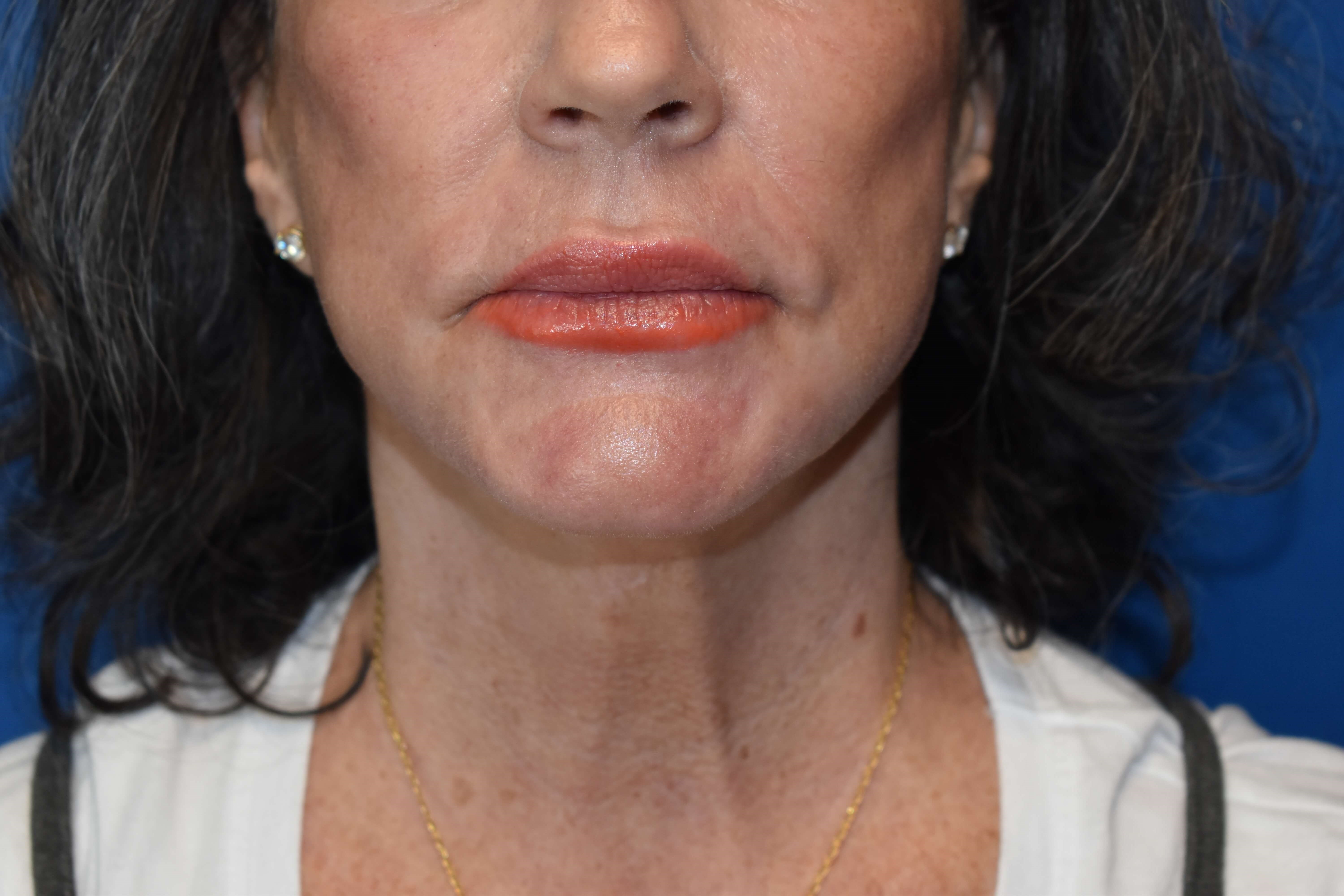 Sciton erbium TRL laser After