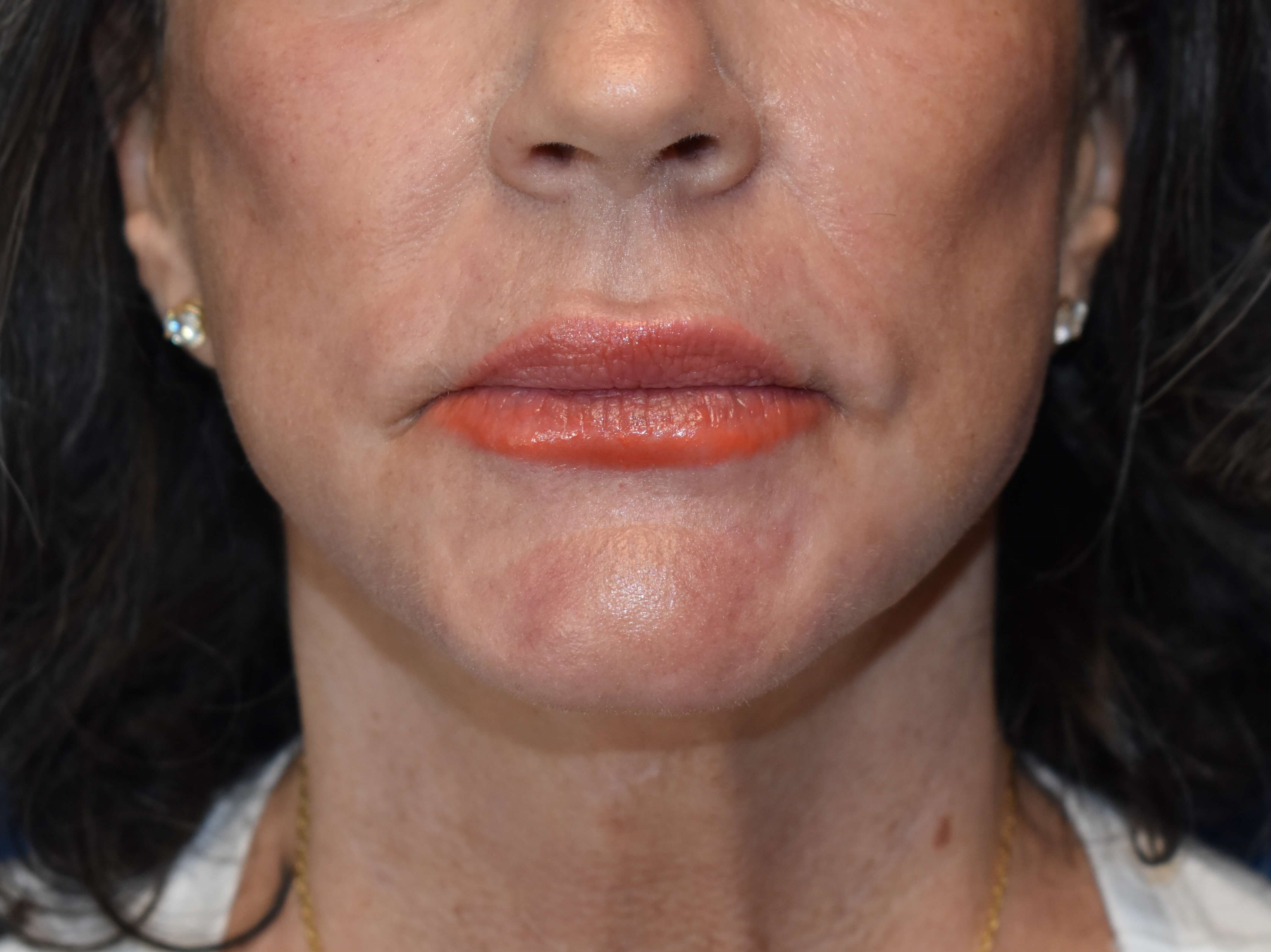 Sciton erbium TRL laser After