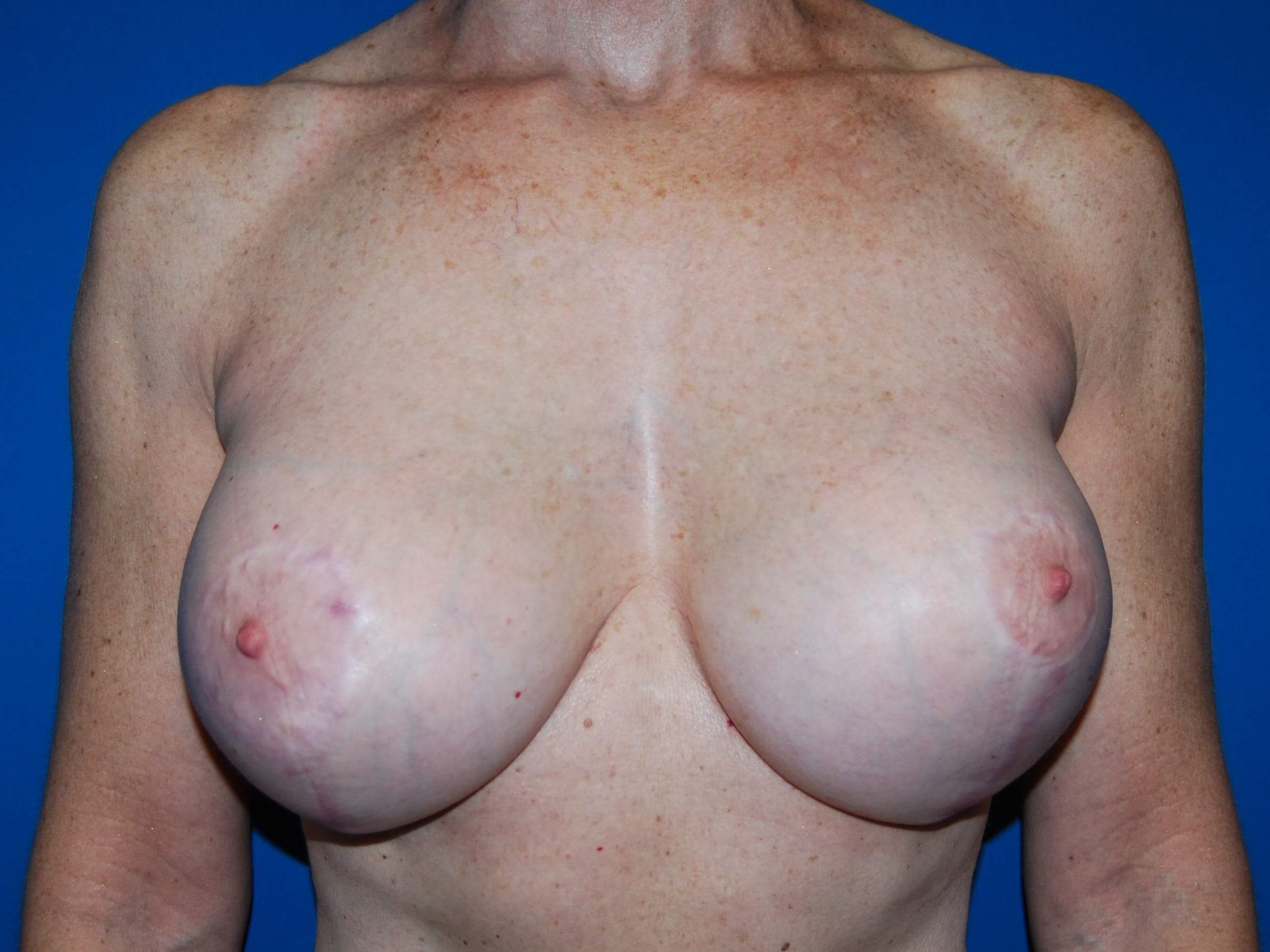 Breast Revision After