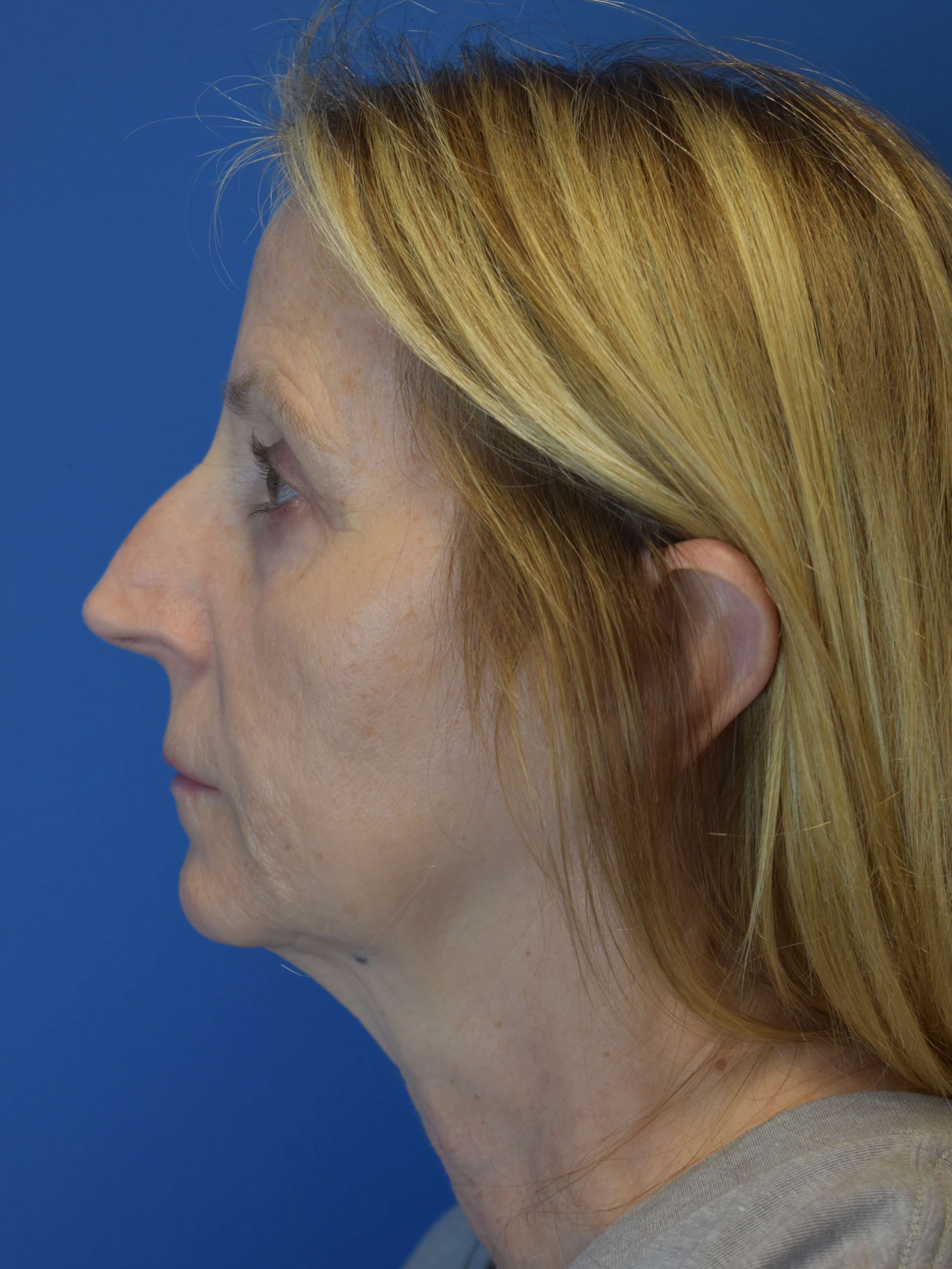 Sofwave -Lower Face and Neck Before