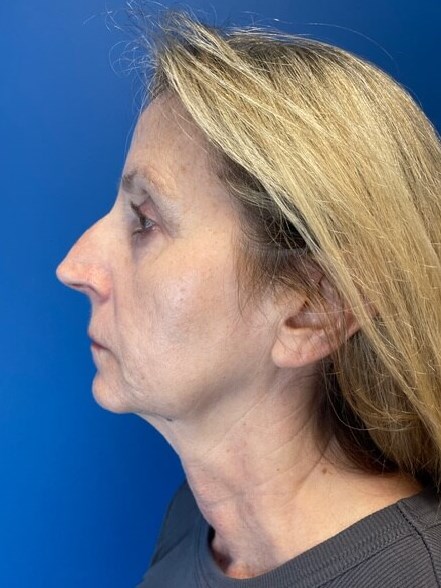 Sofwave -Lower Face and Neck 3 months after treatment