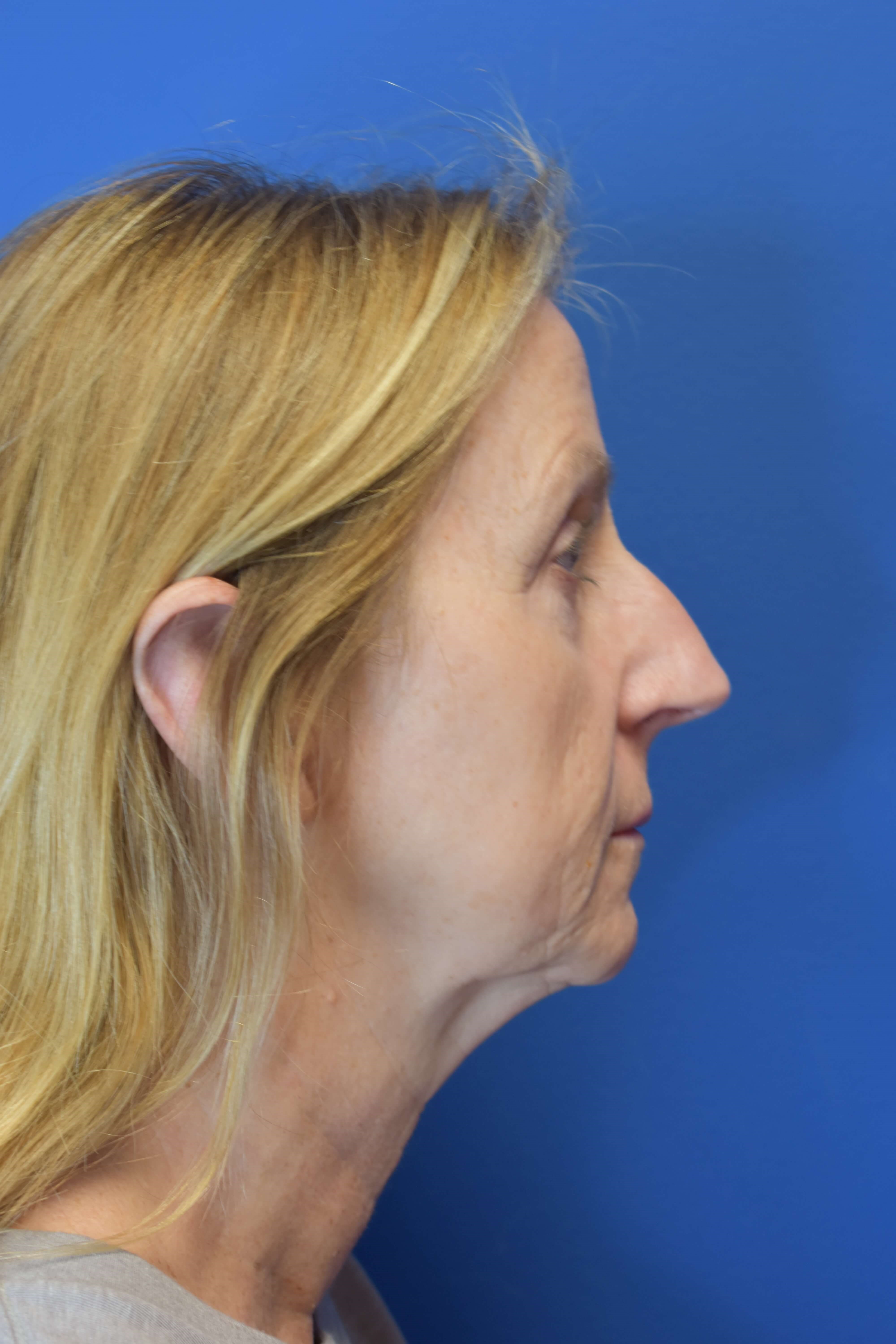 Sofwave -Lower Face and Neck Before