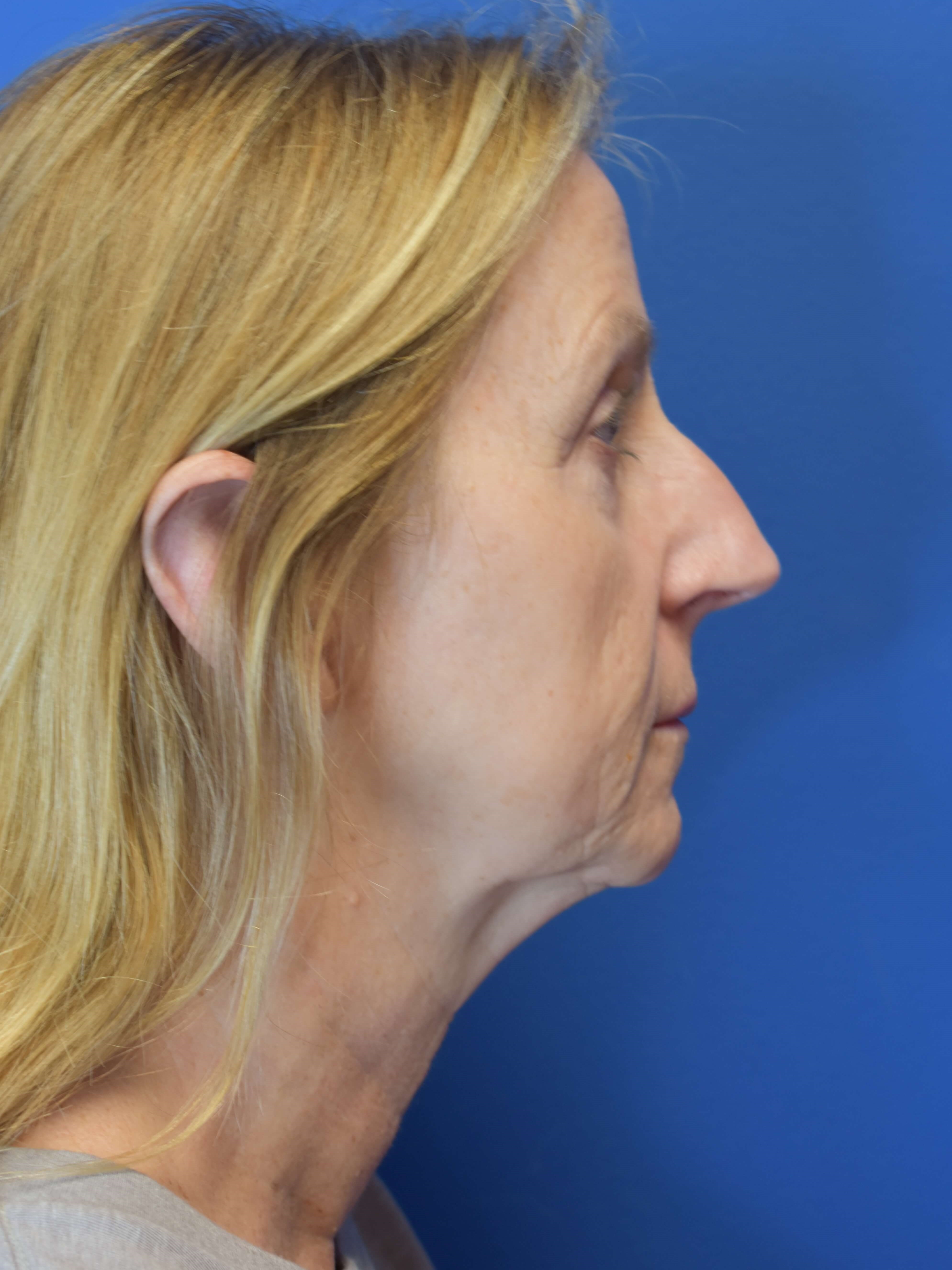 Sofwave -Lower Face and Neck Before