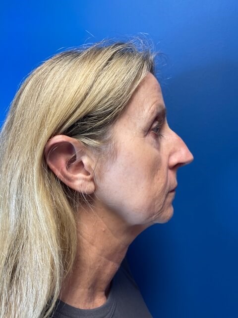 Sofwave -Lower Face and Neck 3 months after treatment