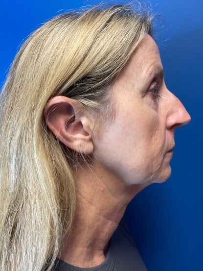 Sofwave -Lower Face and Neck 3 months after treatment