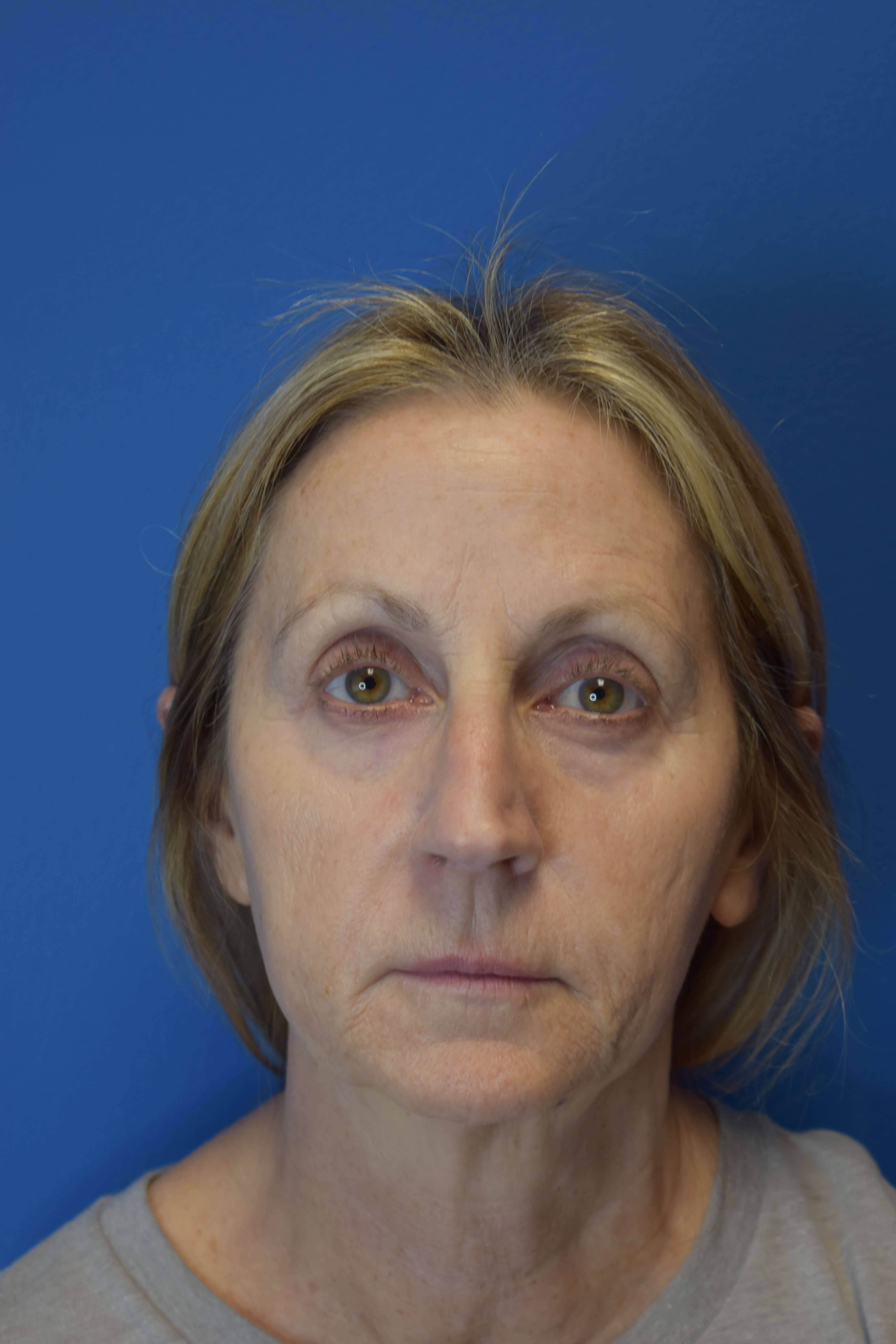 Sofwave -Lower Face and Neck Before