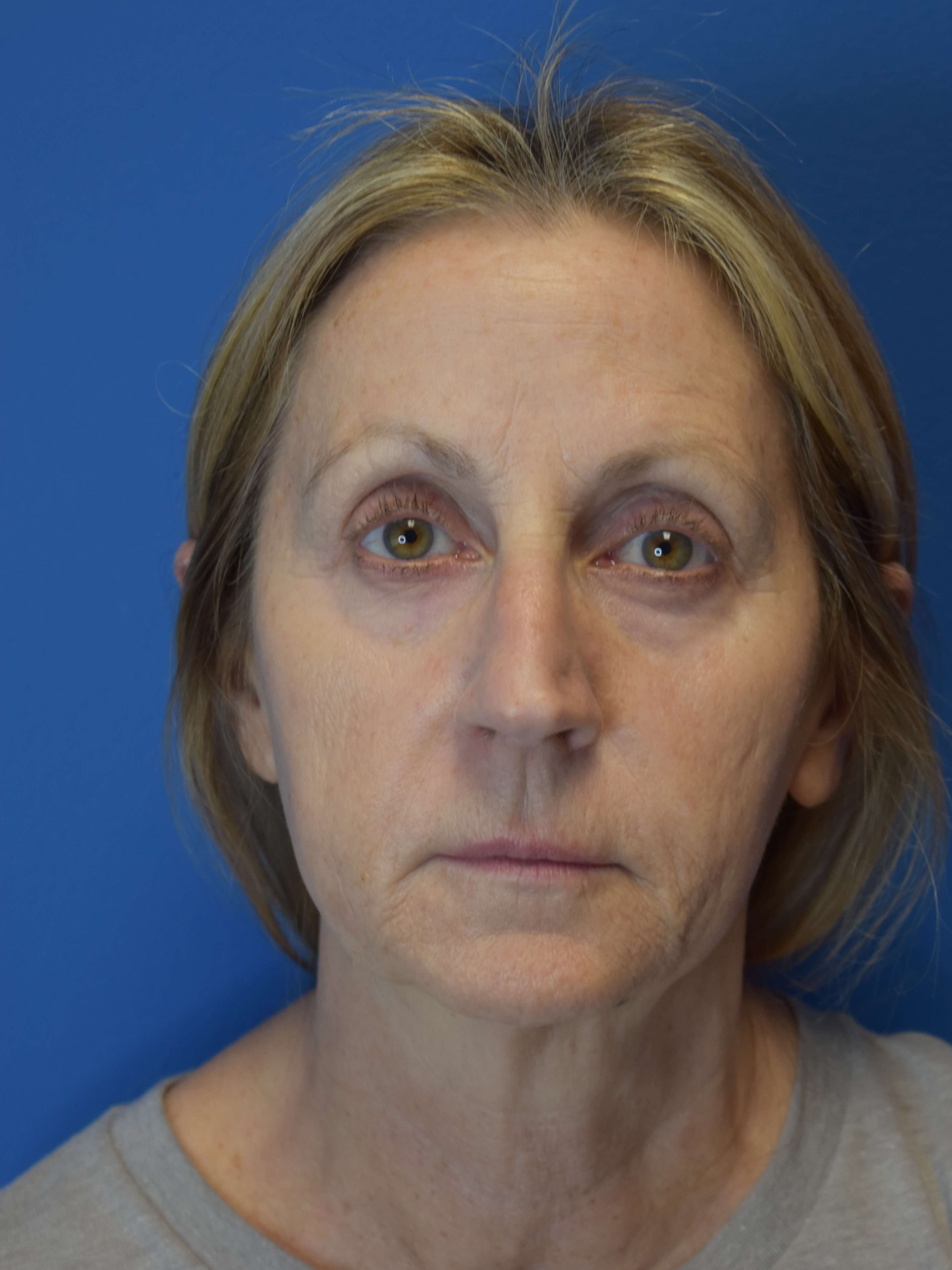 Sofwave -Lower Face and Neck Before