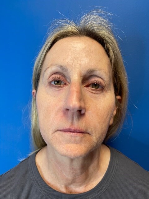 Sofwave -Lower Face and Neck 3 months after treatment