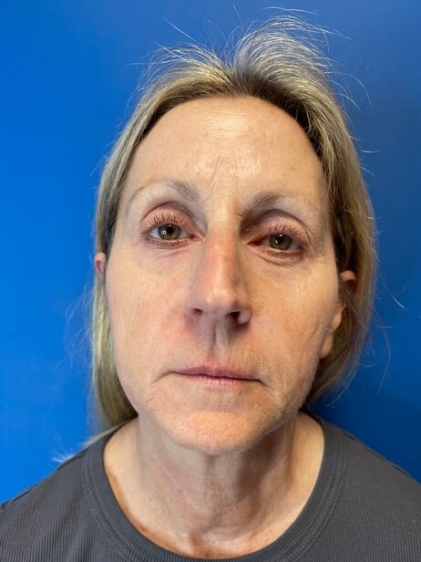 Sofwave -Lower Face and Neck 3 months after treatment