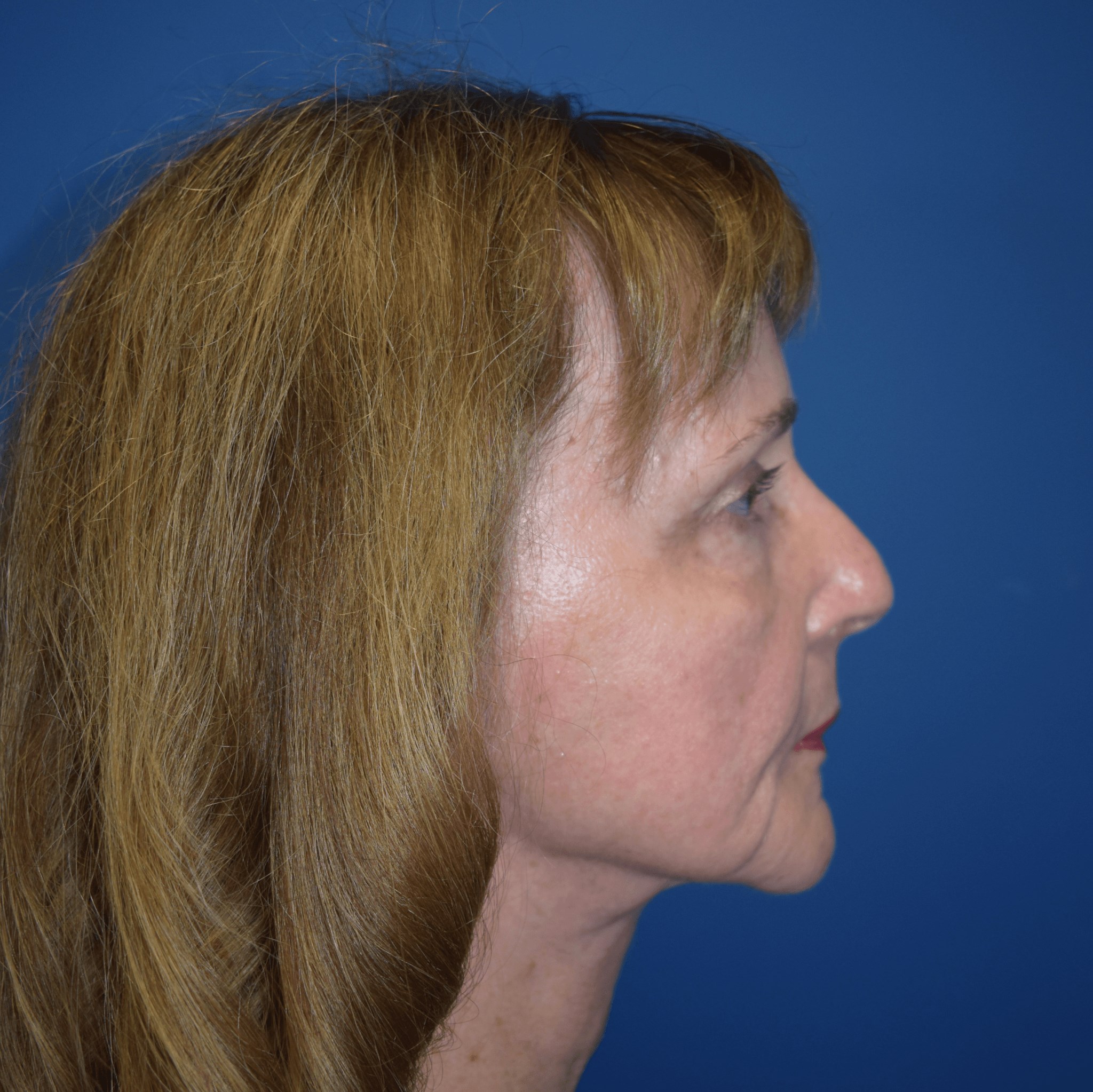Neck Lift After