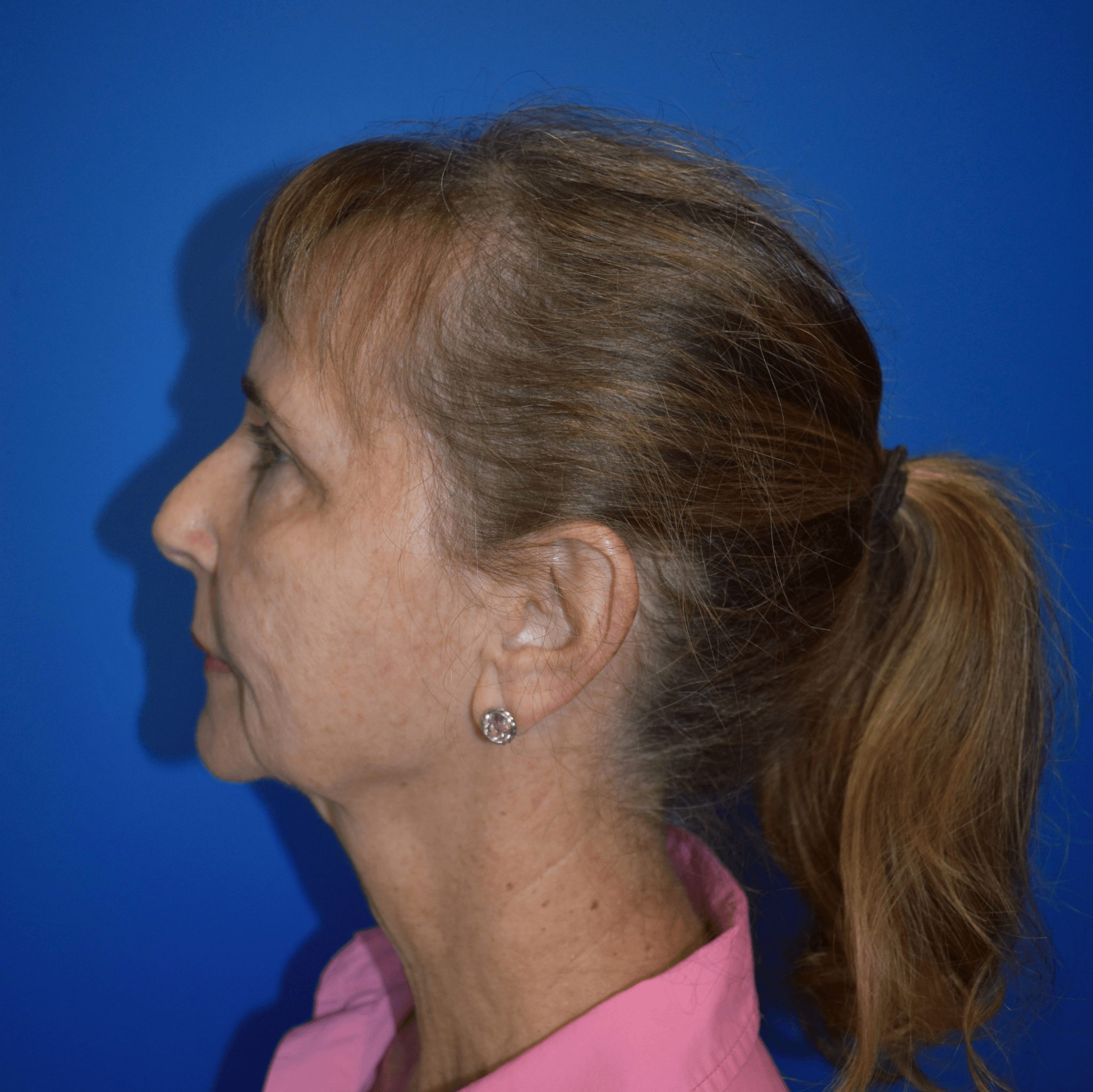 Neck Lift Before