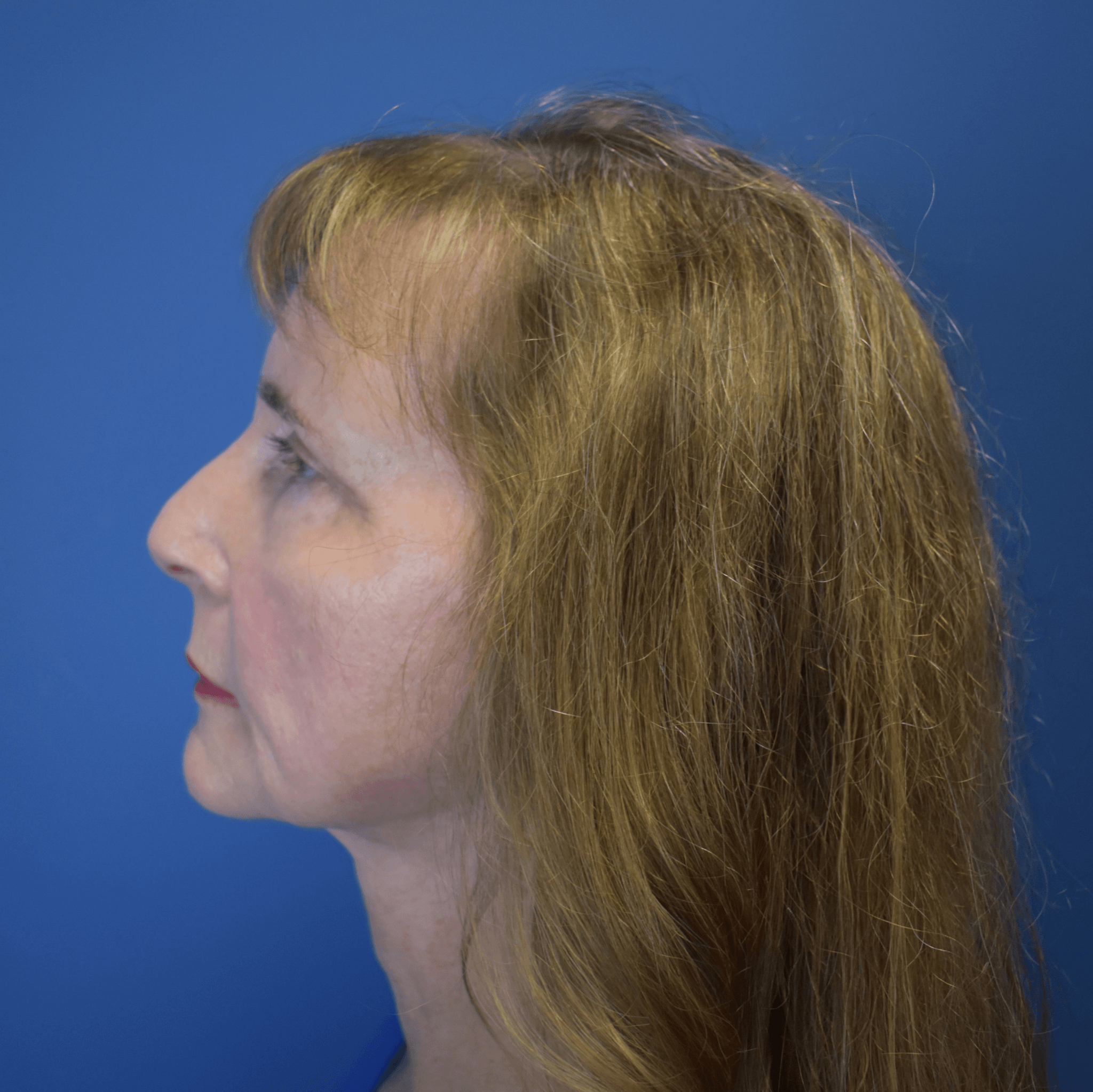 Neck Lift After