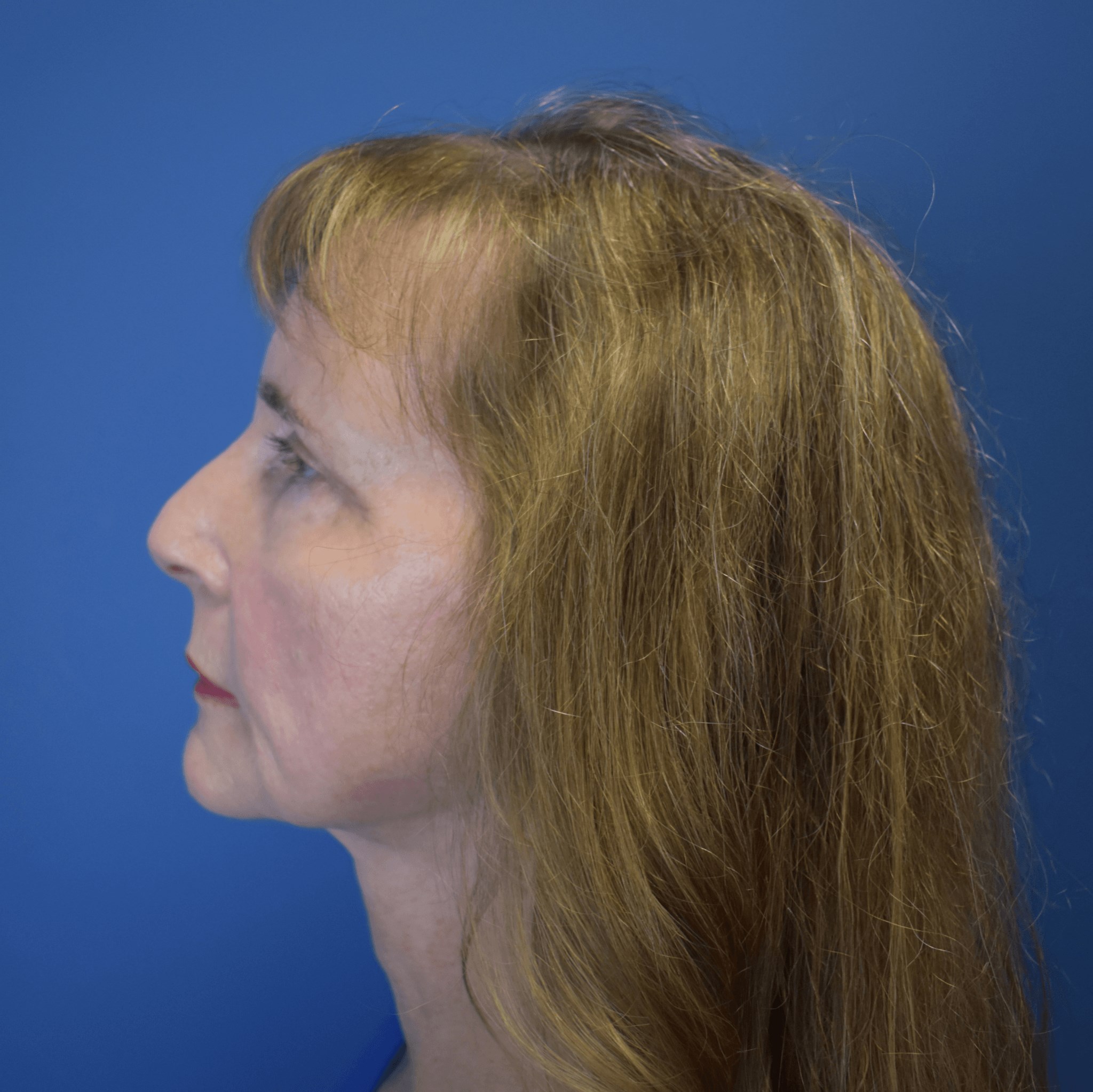 Neck Lift After