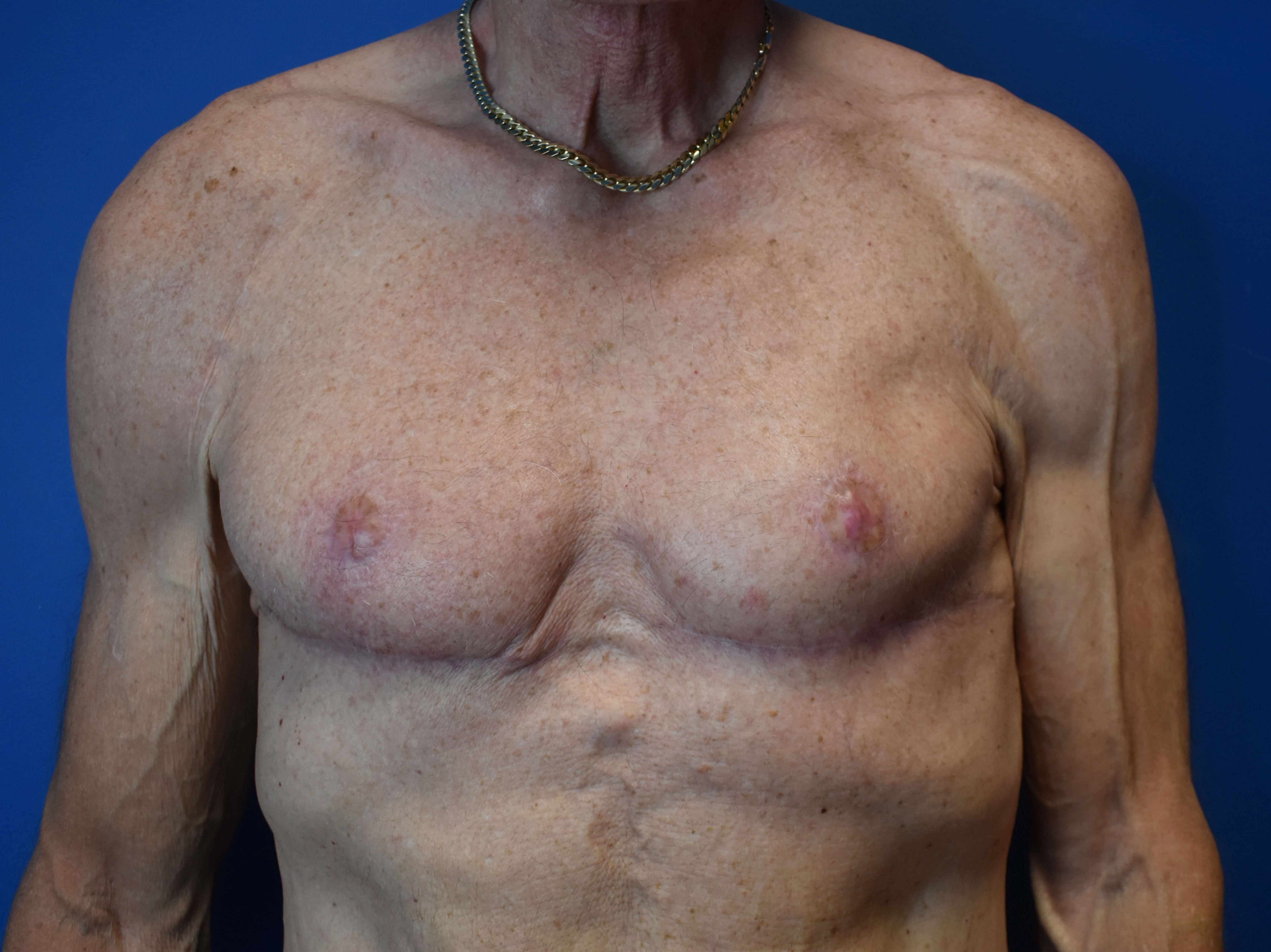 Gynecosmastia After
