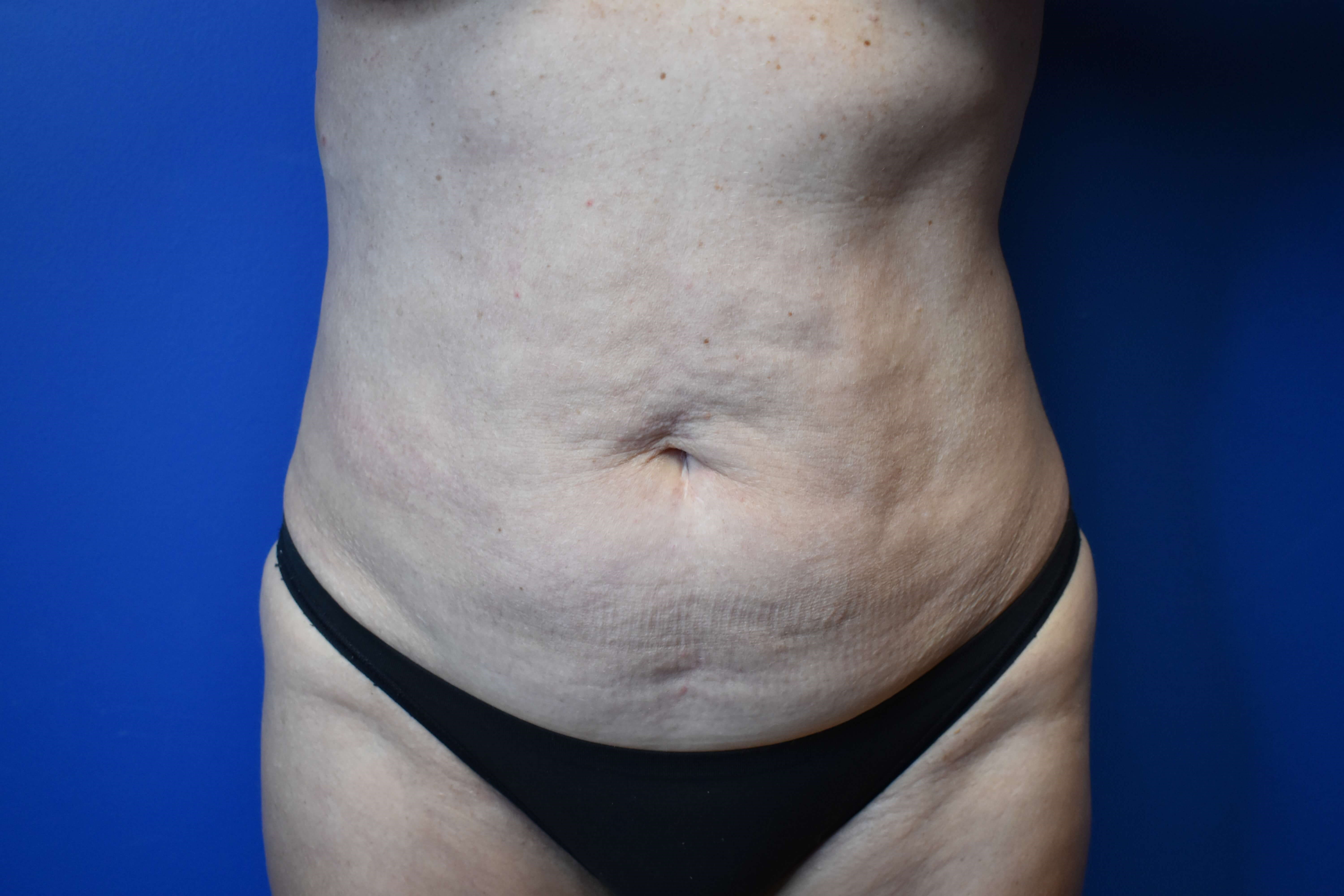 Abdominoplasty with Vaser Lipo Before