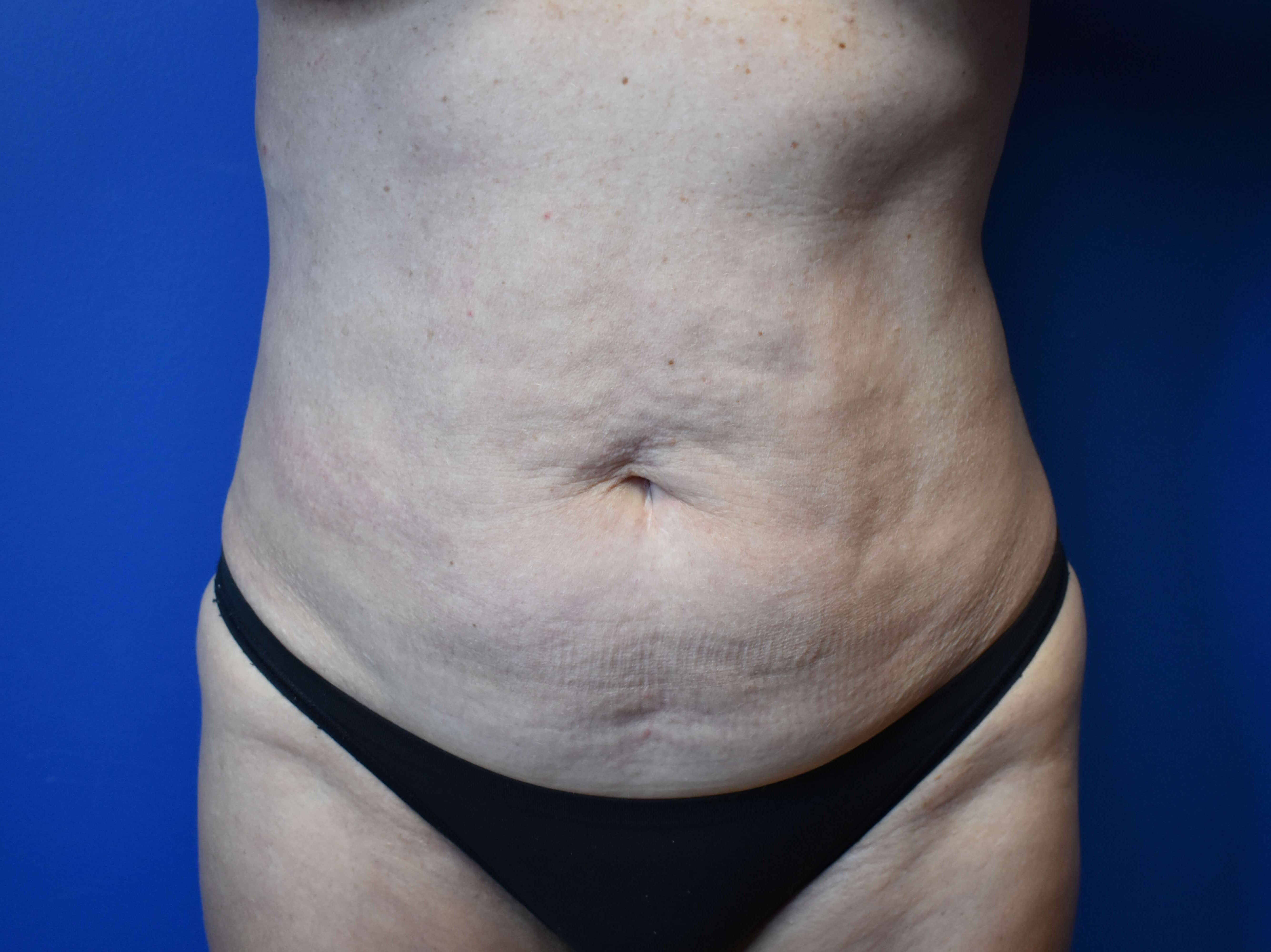 Abdominoplasty with Vaser Lipo Before
